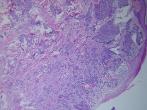 CARCINOMA MUCOCUTÁNEO