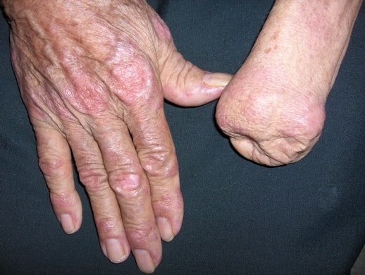 DERMATOMIOSITIS