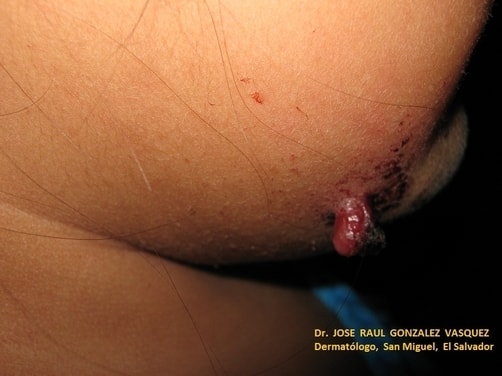 GRANULOMA PIÓGENO