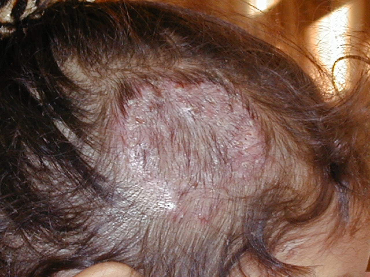 TINEA CABEZA