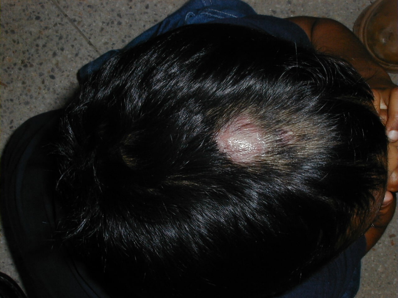 TINEA CABEZA