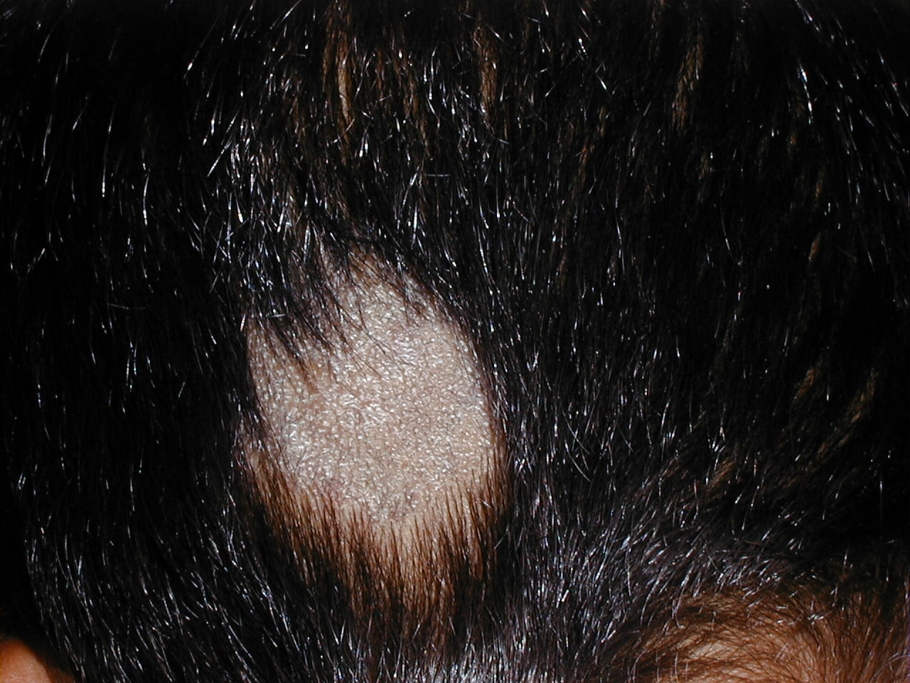 TINEA CABEZA