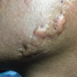 ACNE CONGLOBATA  -  ISOTRETINOINA