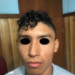 ACNE CONGLOBATA  -  ISOTRETINOINA