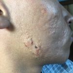 ACNE CONGLOBATA  -  ISOTRETINOINA