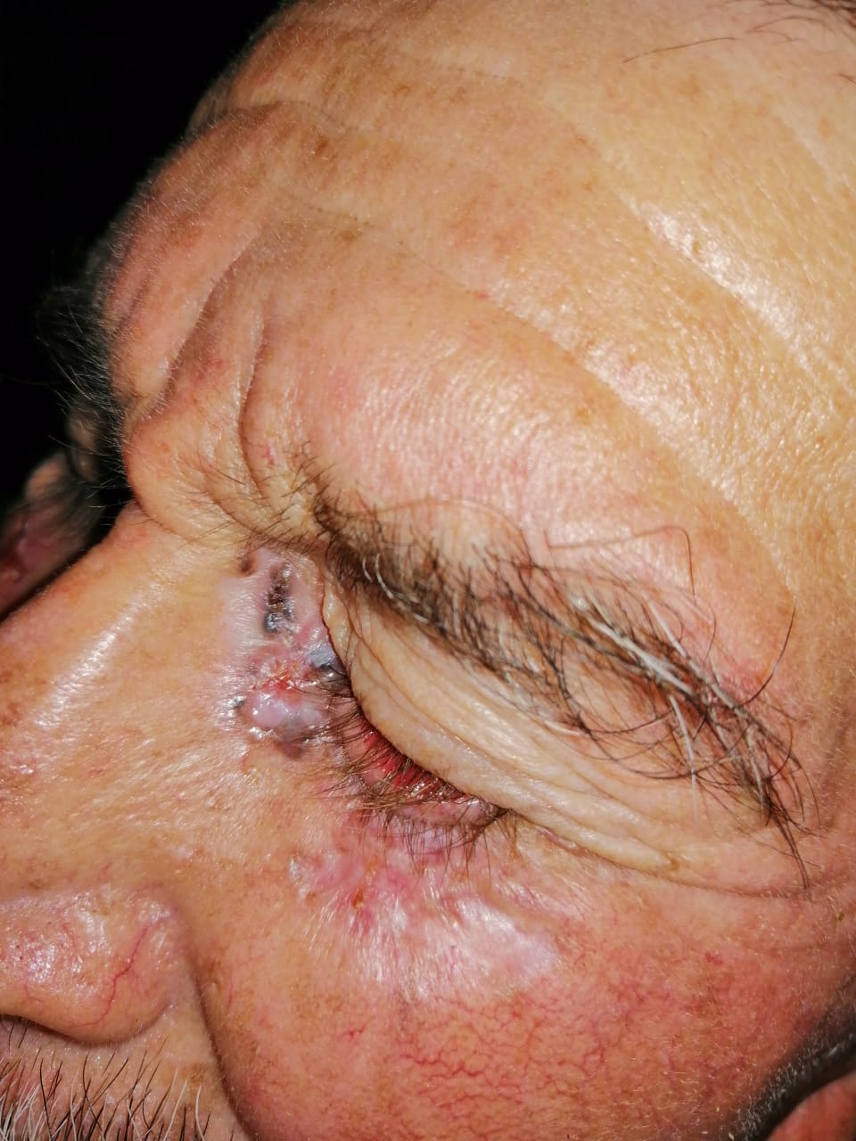 CARCINOMA BASOCELULAR - PARPADO