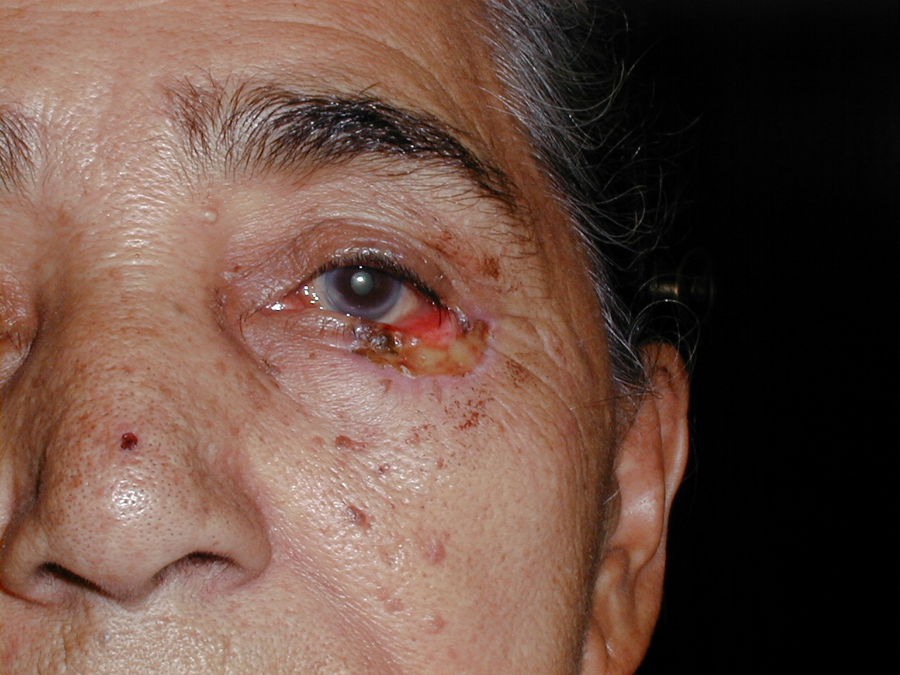 CARCINOMA BASOCELULAR - PARPADO