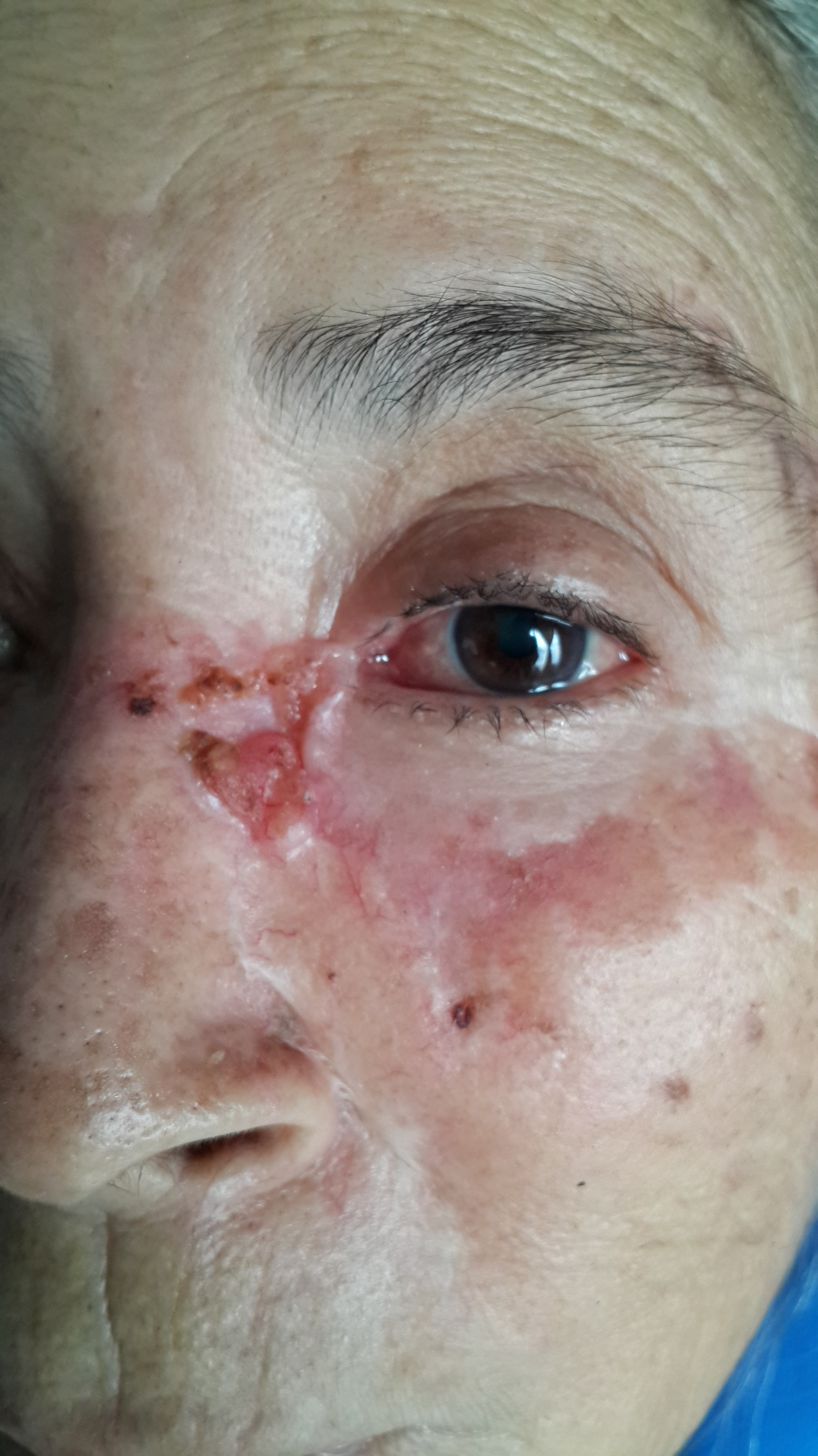 CARCINOMA BASOCELULAR - PARPADO