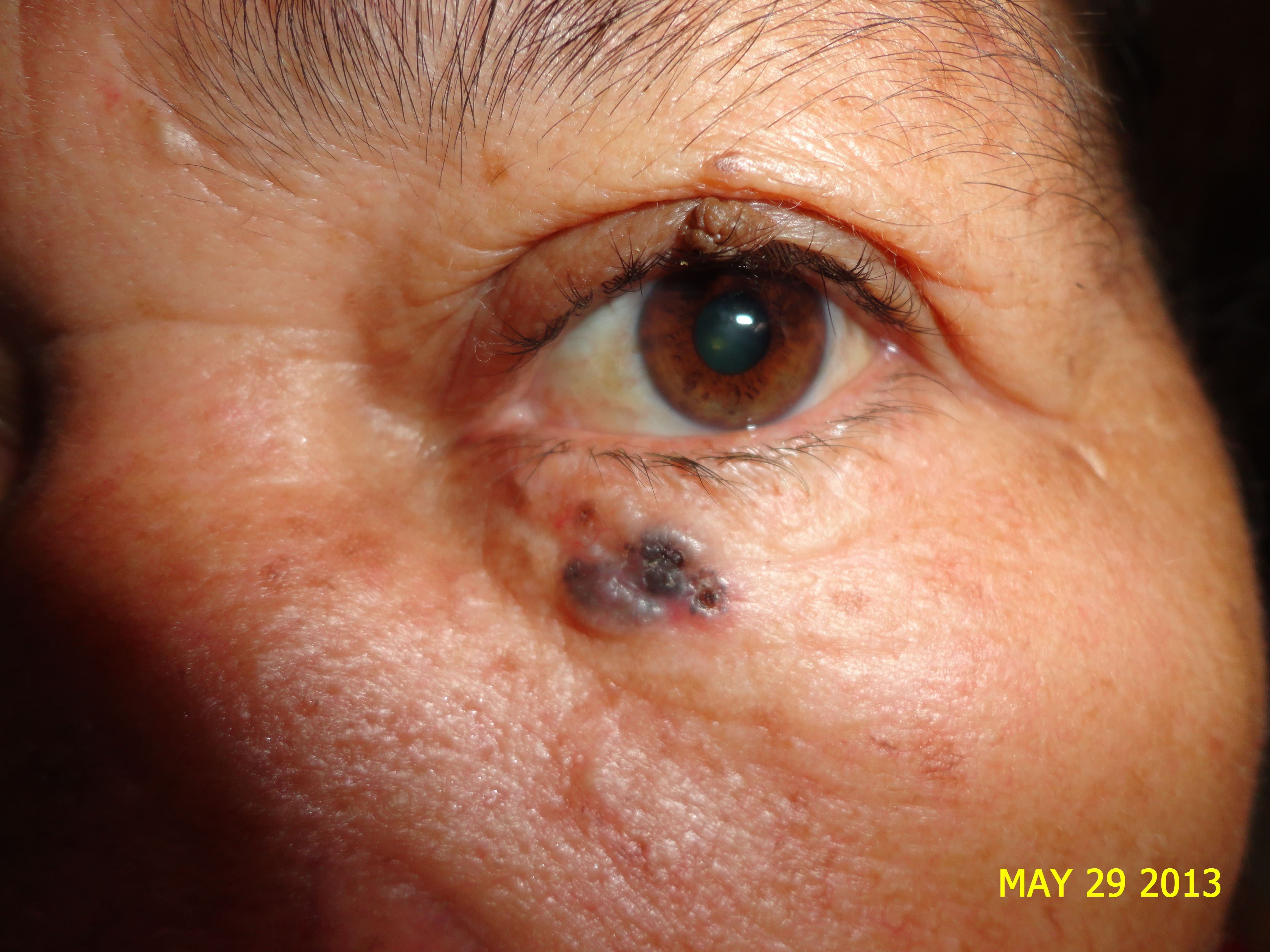 CARCINOMA BASOCELULAR - PARPADO