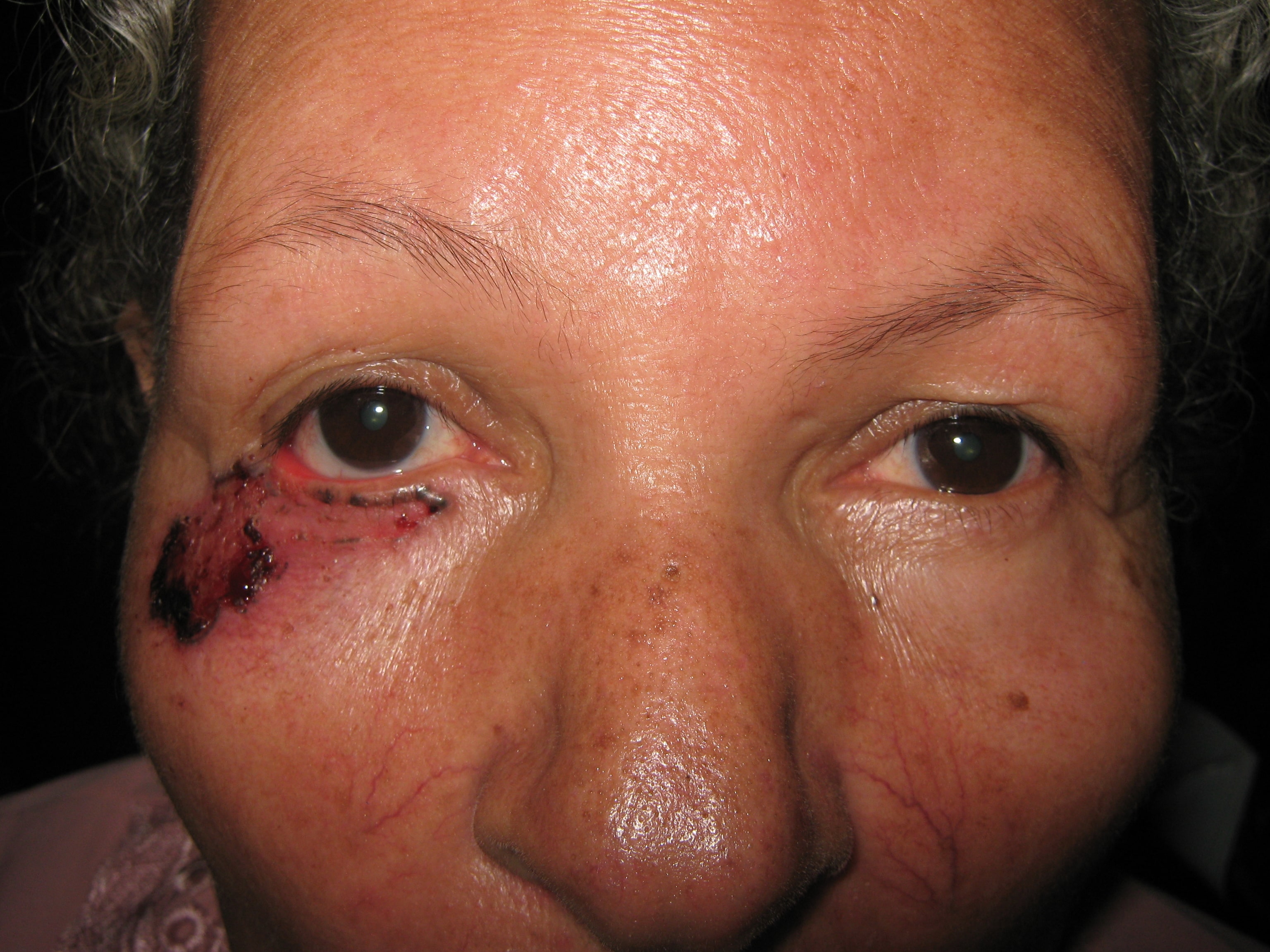 CARCINOMA BASOCELULAR - PARPADO