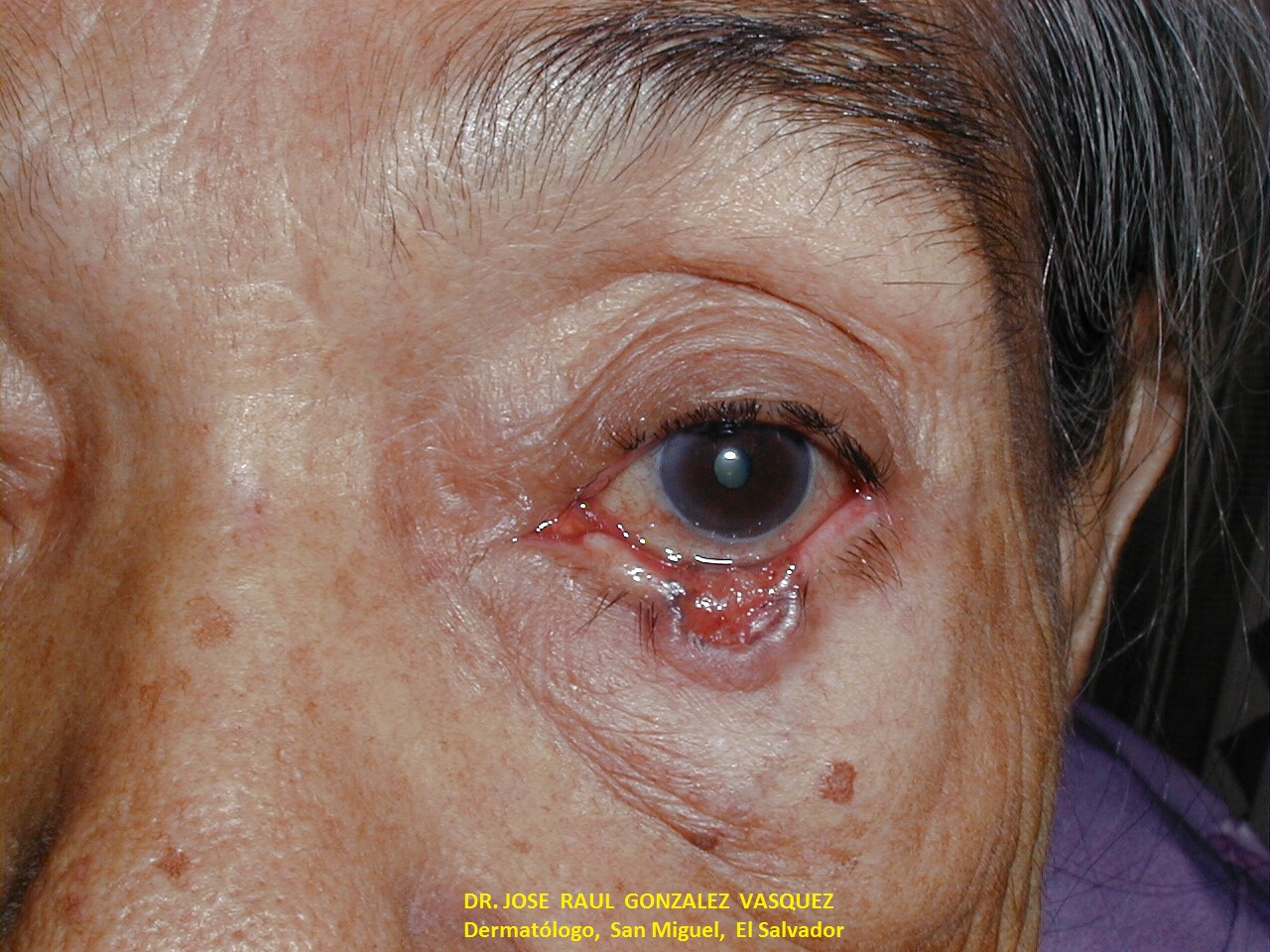 CARCINOMA BASOCELULAR - PARPADO