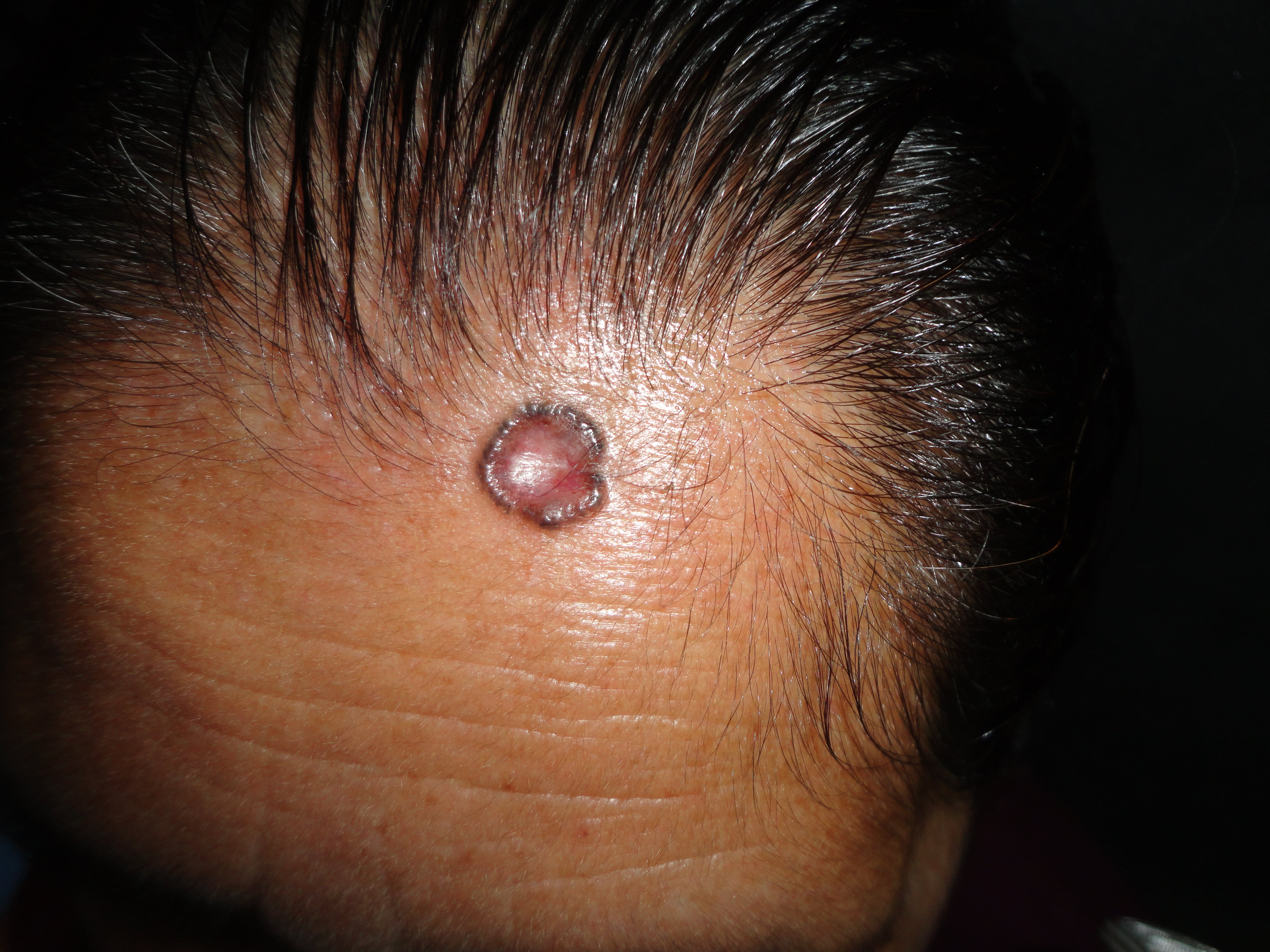 CARCINOMA BASOCELULAR DE LA FRENTE