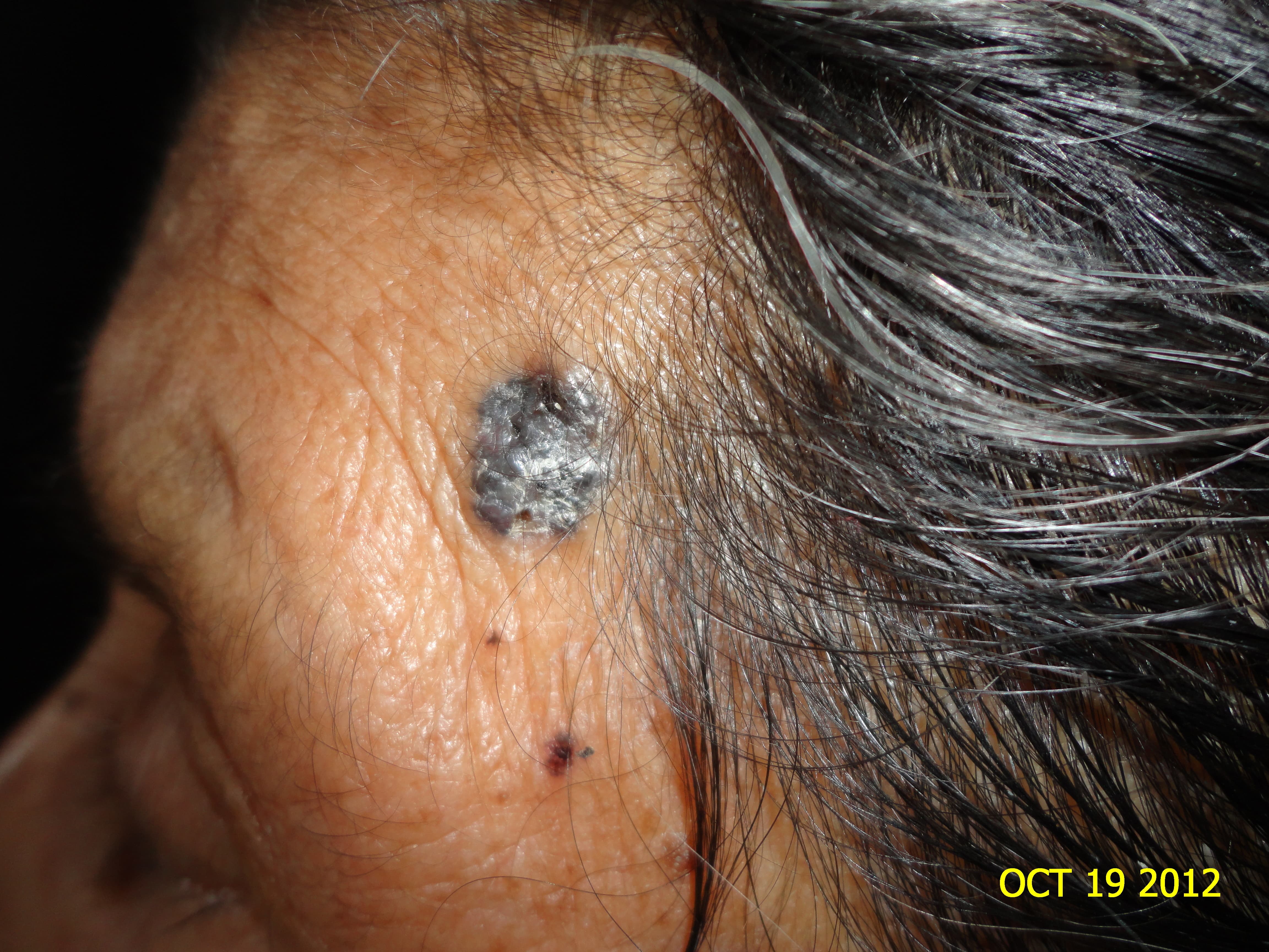 CARCINOMA BASOCELULAR DE LA FRENTE