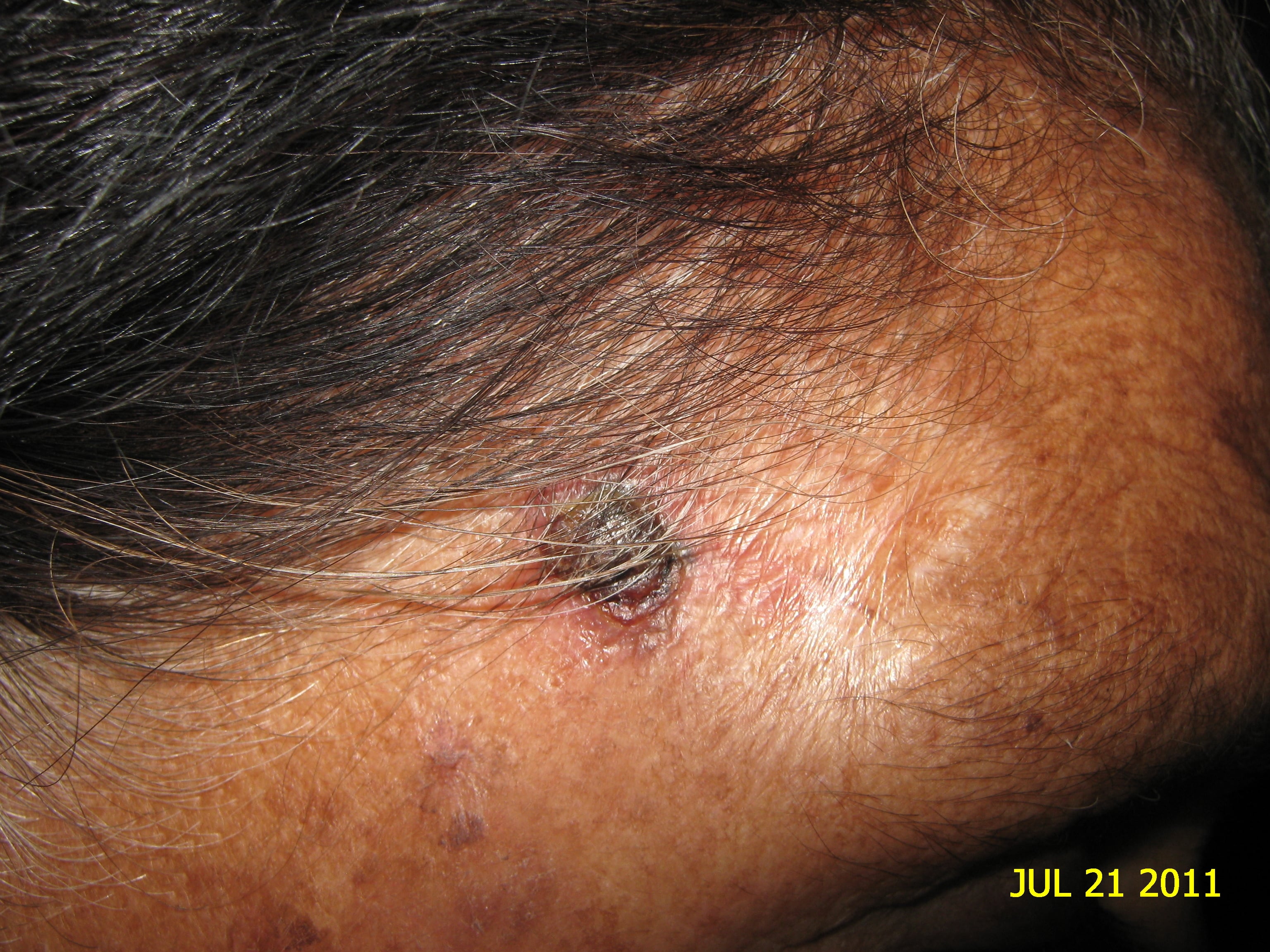 CARCINOMA BASOCELULAR DE LA FRENTE