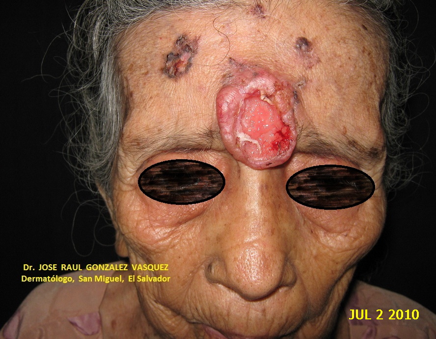 CARCINOMA BASOCELULAR MULTIPLES