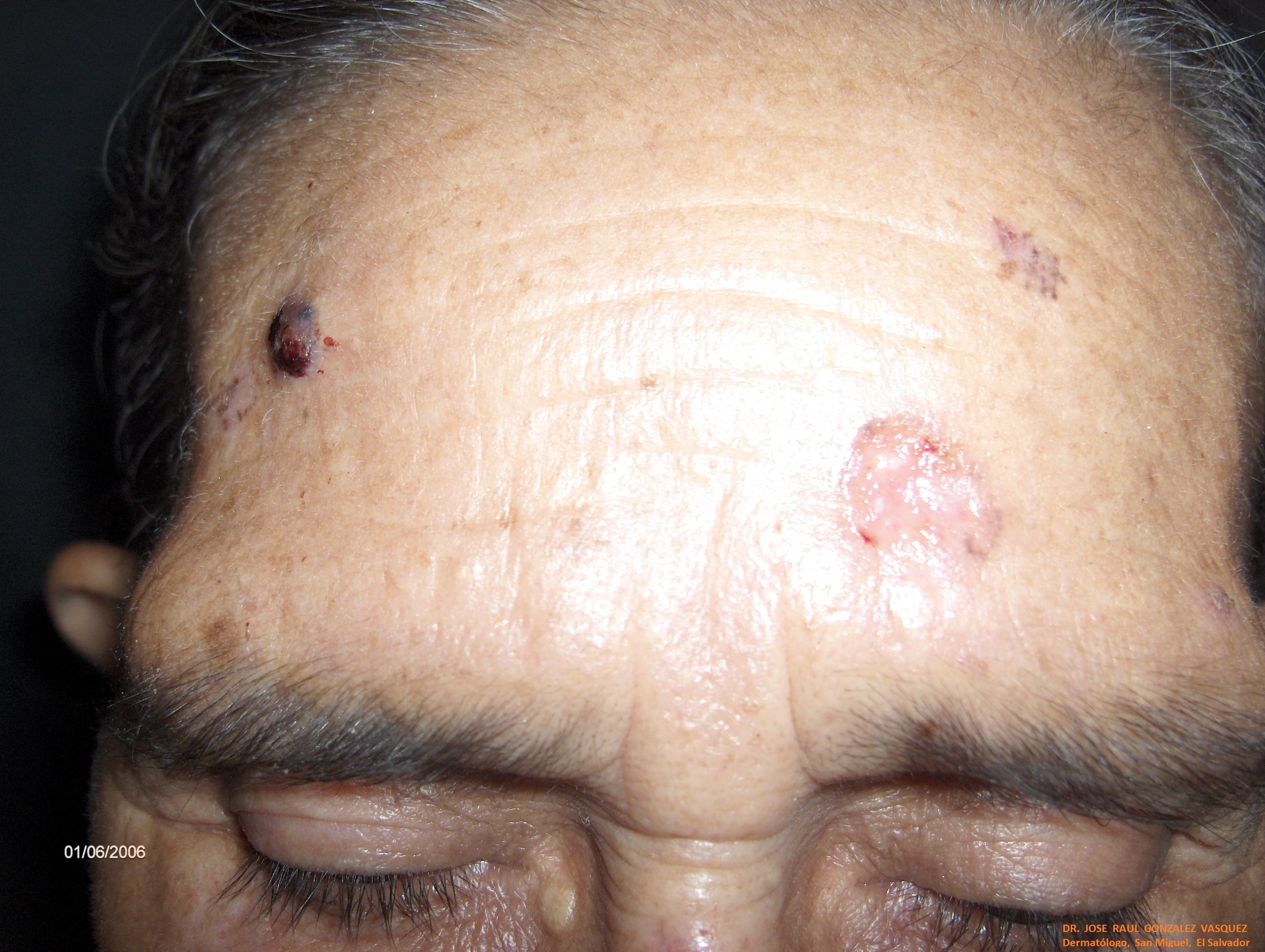 CARCINOMA BASOCELULAR MULTIPLES