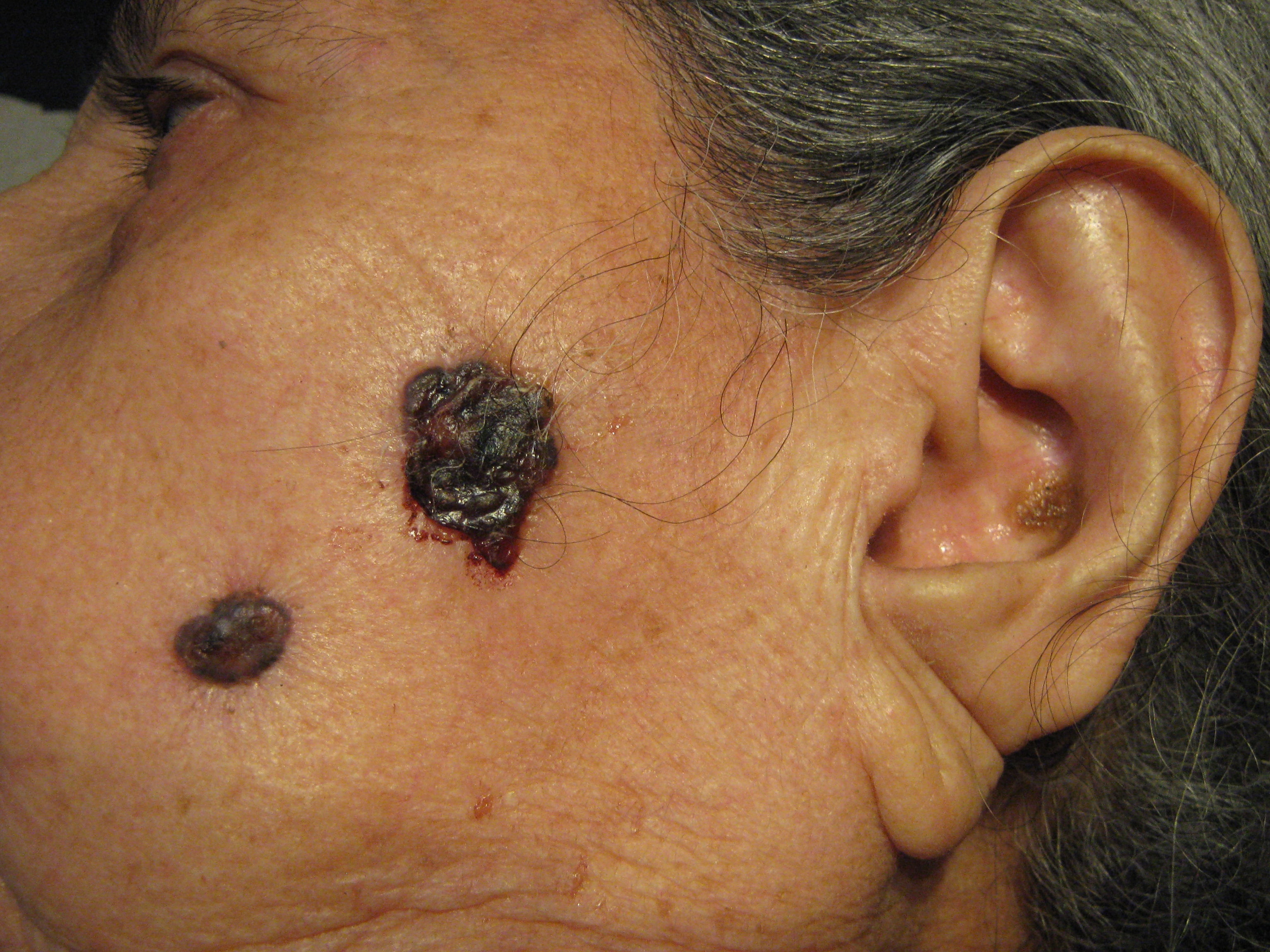 CARCINOMA BASOCELULAR MULTIPLES