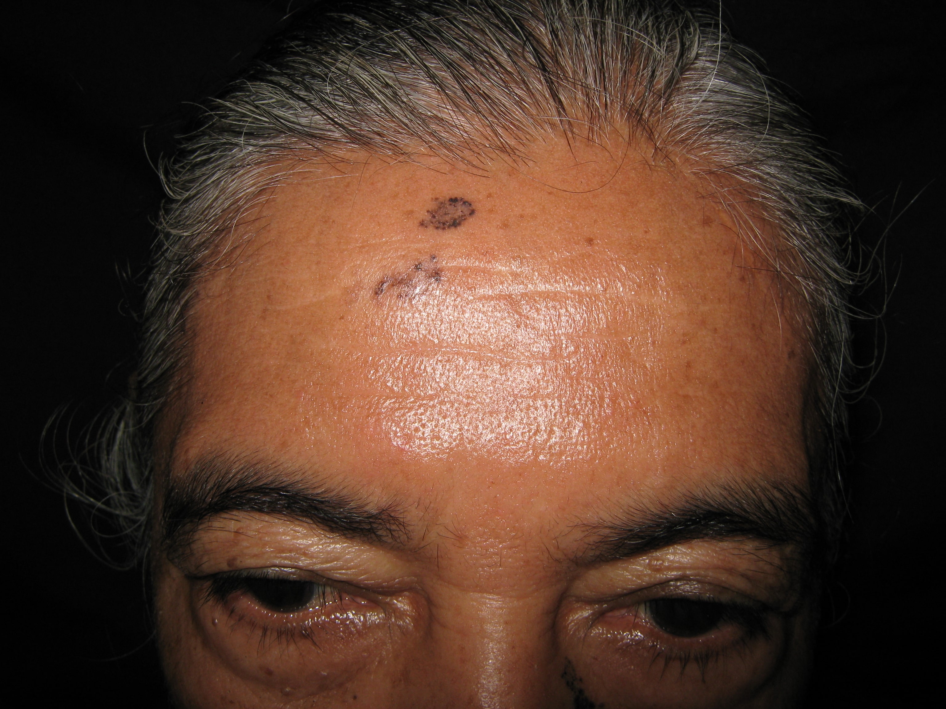 CARCINOMA BASOCELULAR MULTIPLES