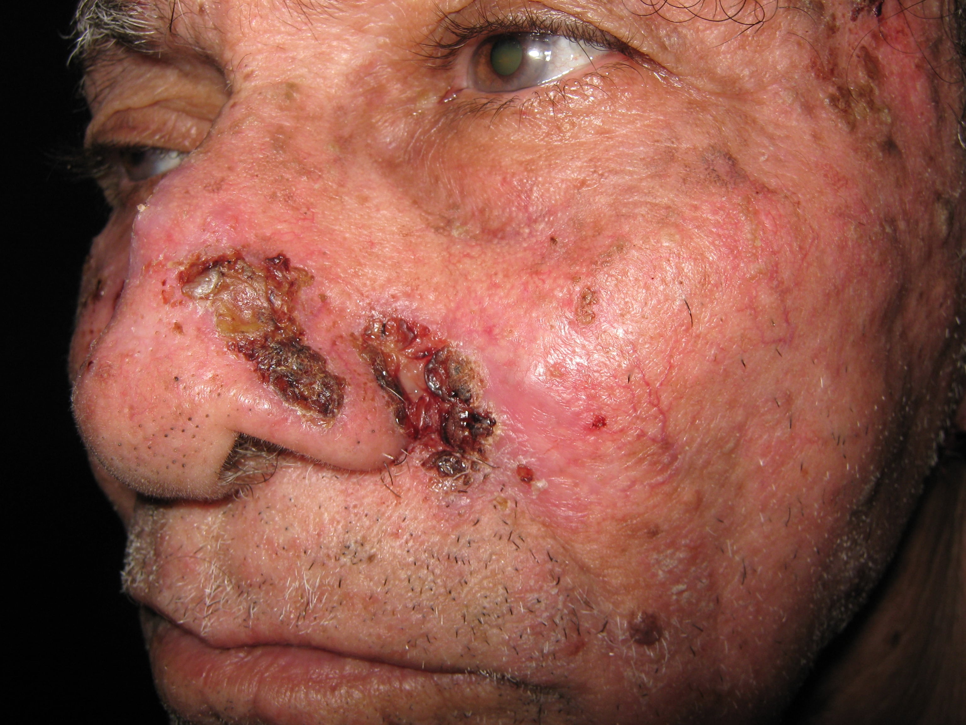 CARCINOMA BASOCELULAR MULTIPLES