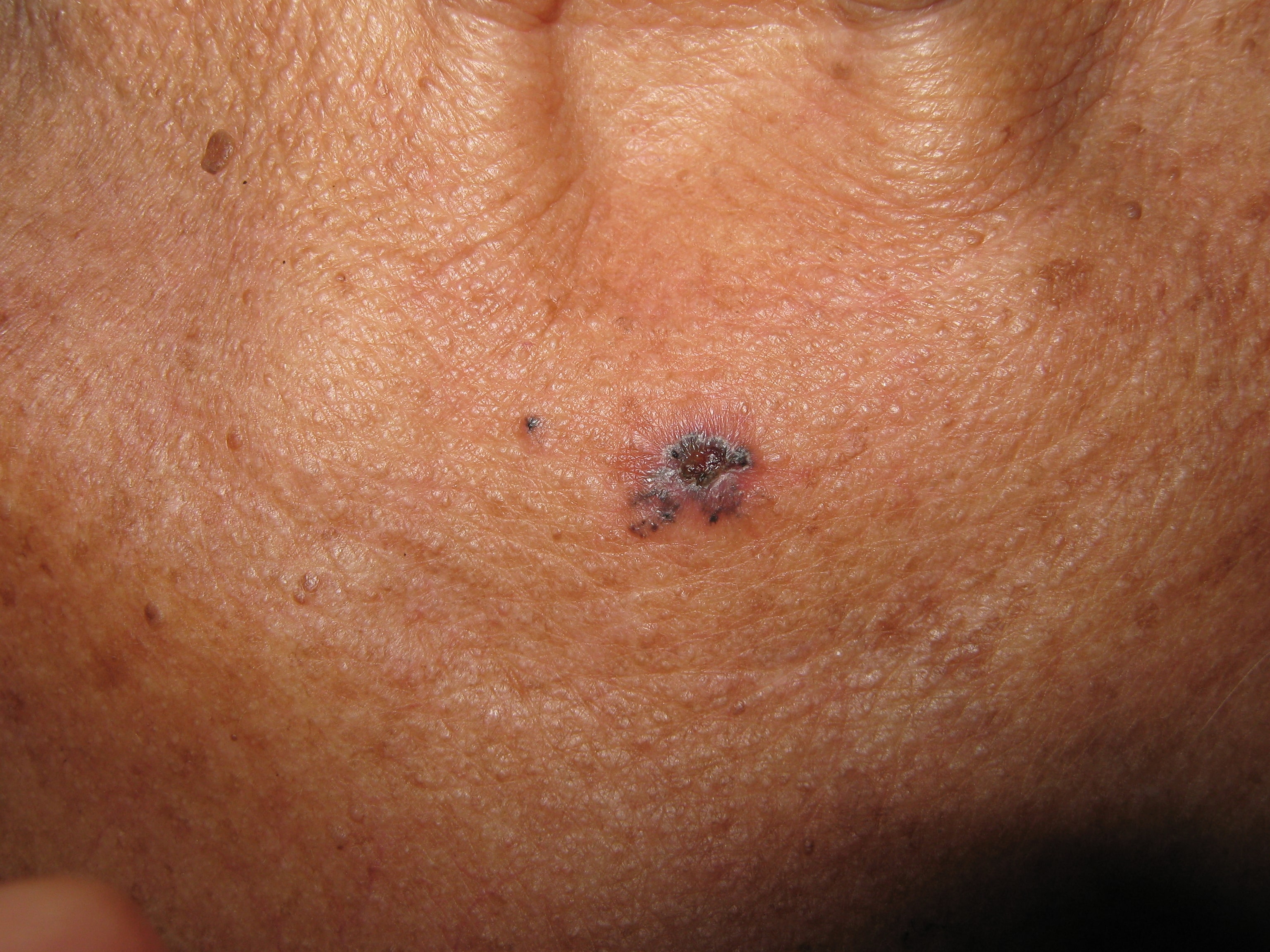 CARCINOMA BASOCELULAR V DEL ESCOTE