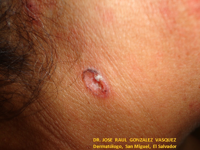 CARCINOMA BASOCELULAR DEL CUELLO