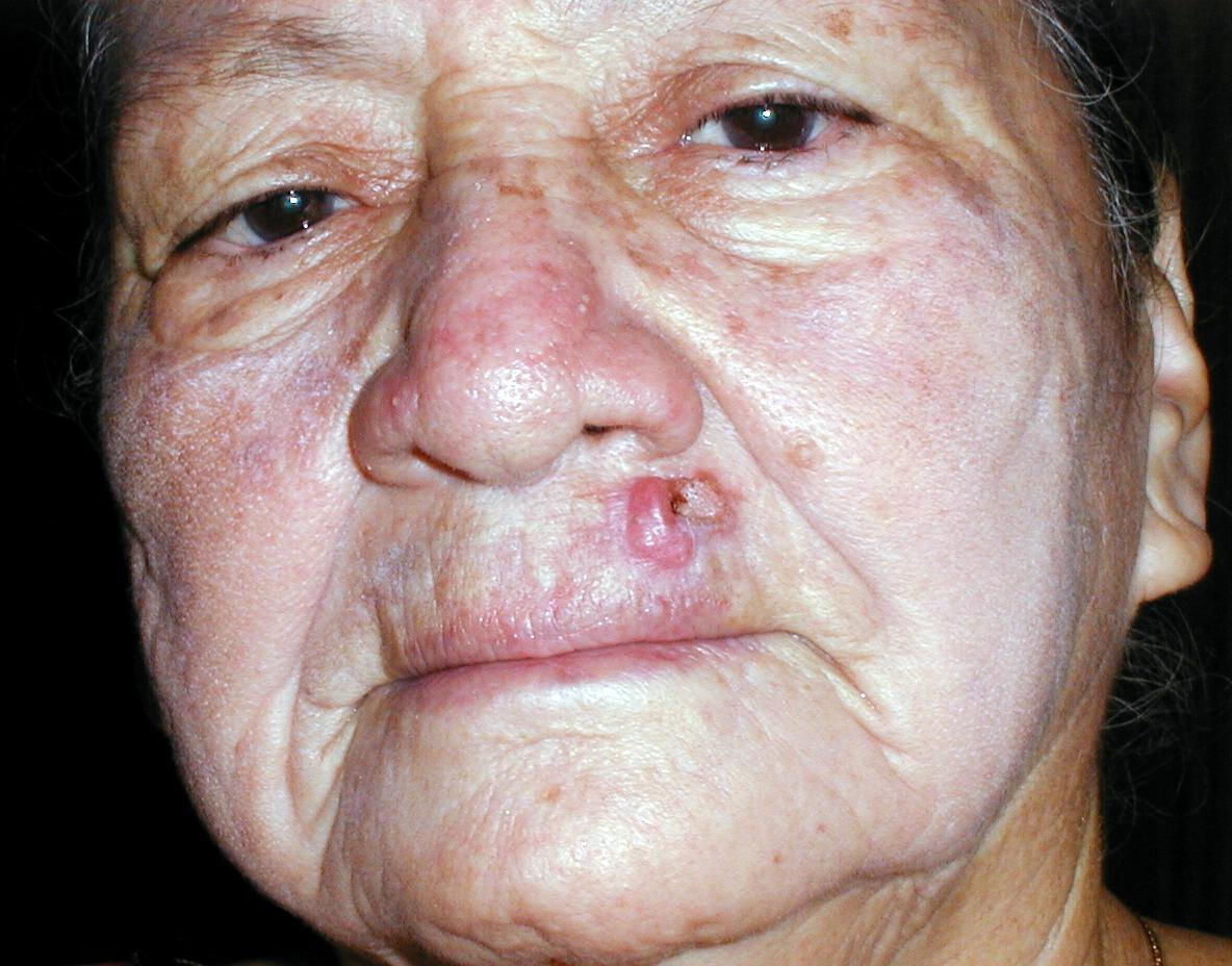 CARCINOMA BASOCELULAR DE LA CARA