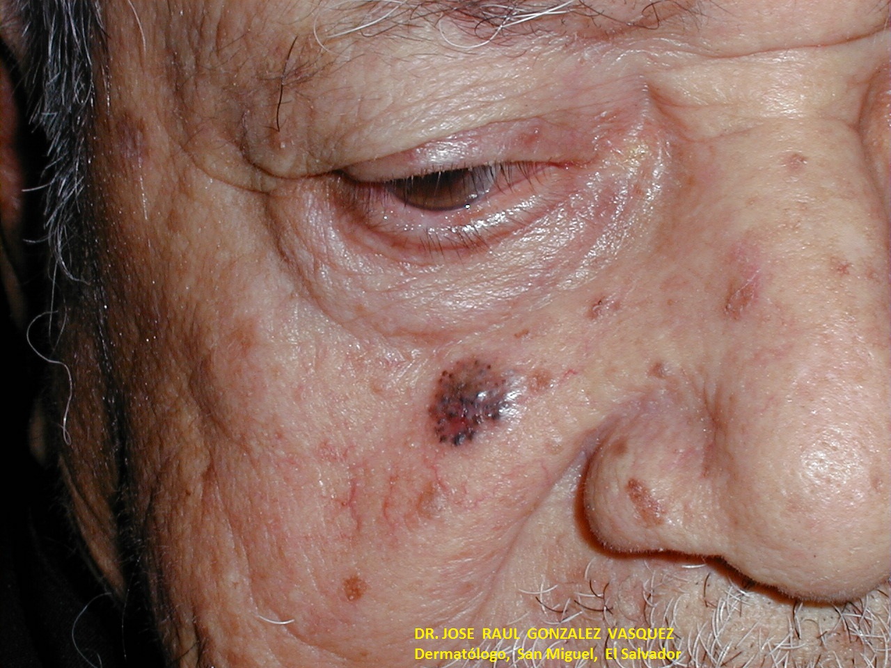 CARCINOMA BASOCELULAR DE LA CARA