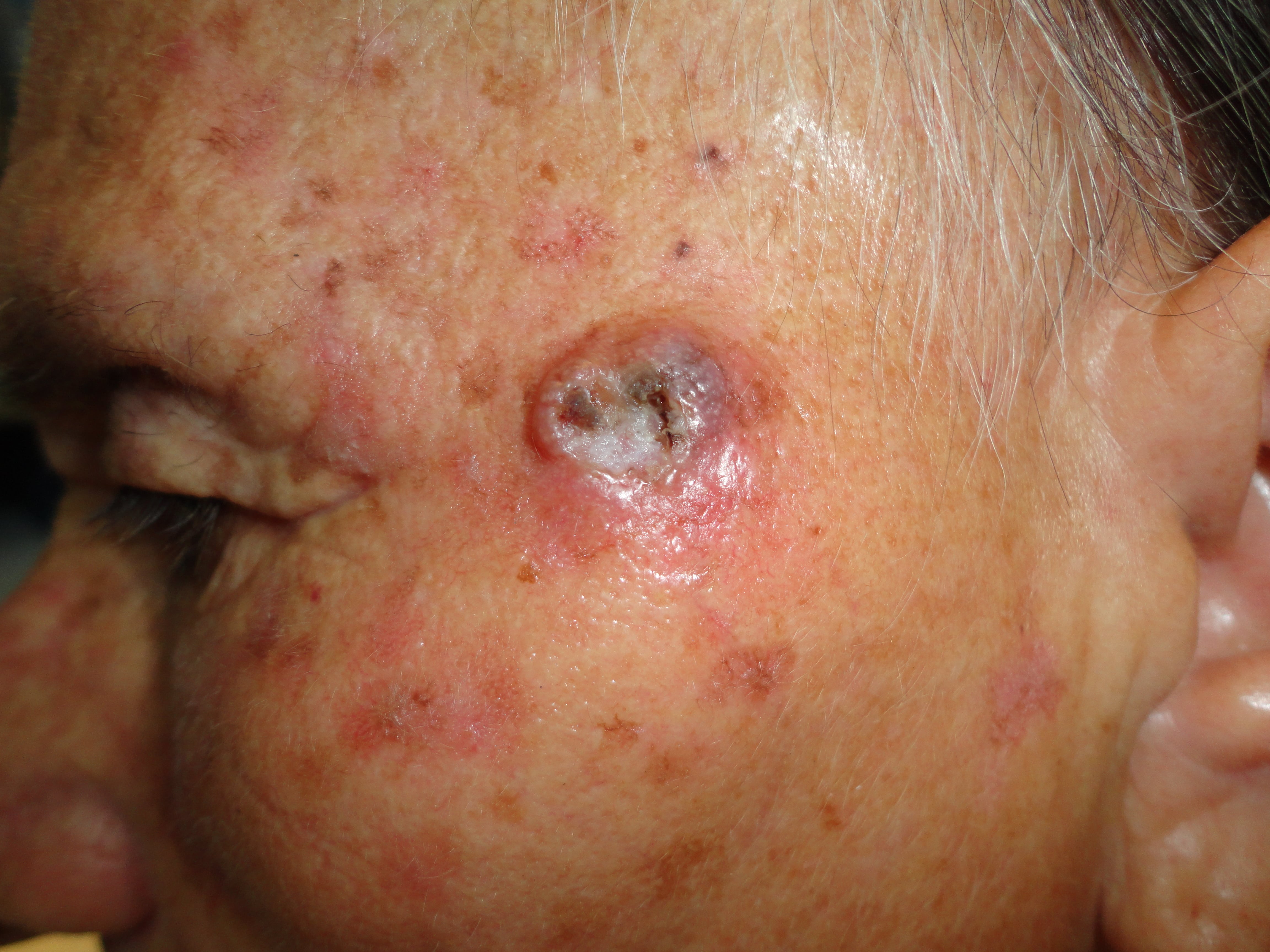 CARCINOMA BASOCELULAR DE LA CARA