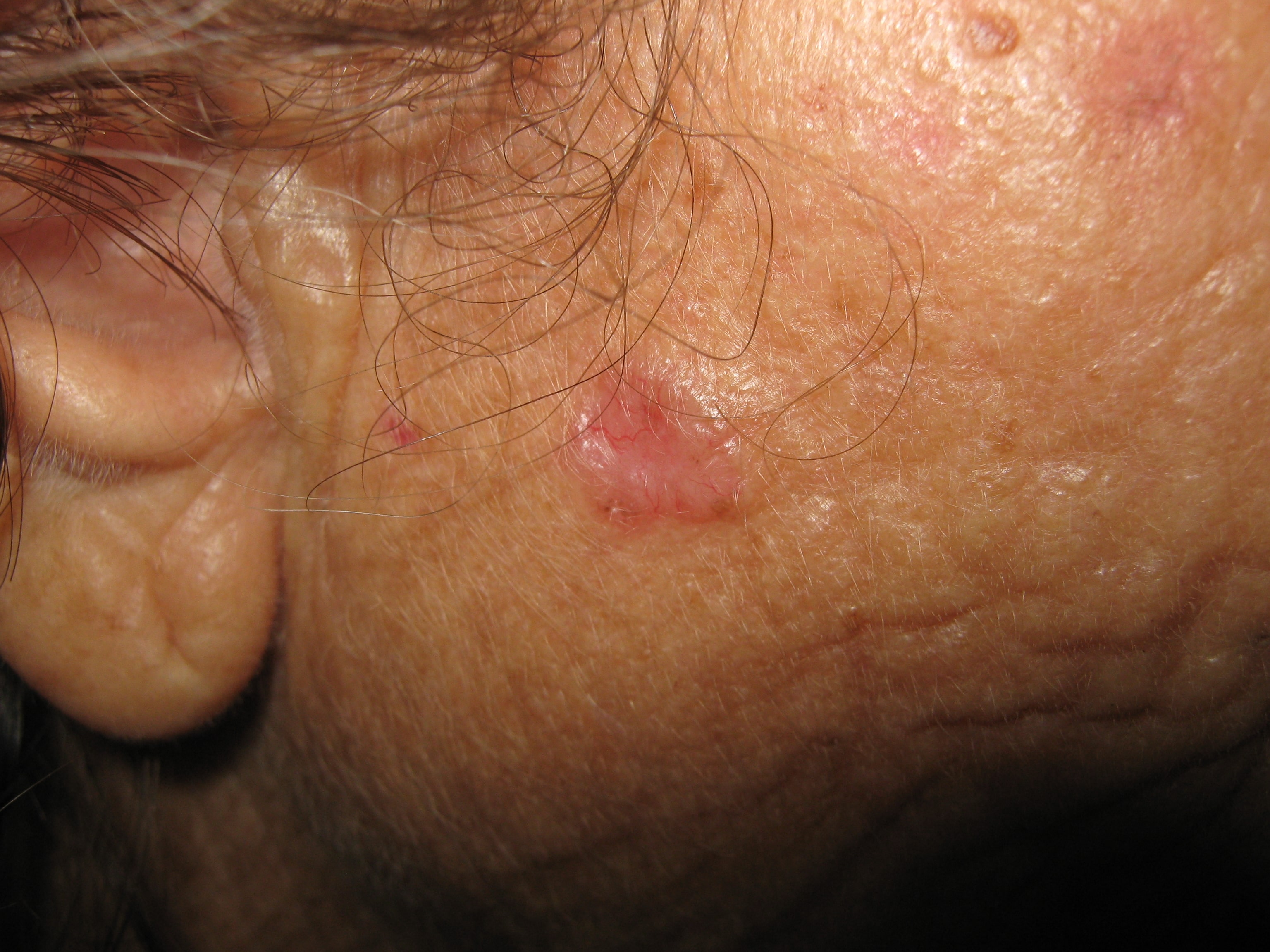 CARCINOMA BASOCELULAR DE LA CARA