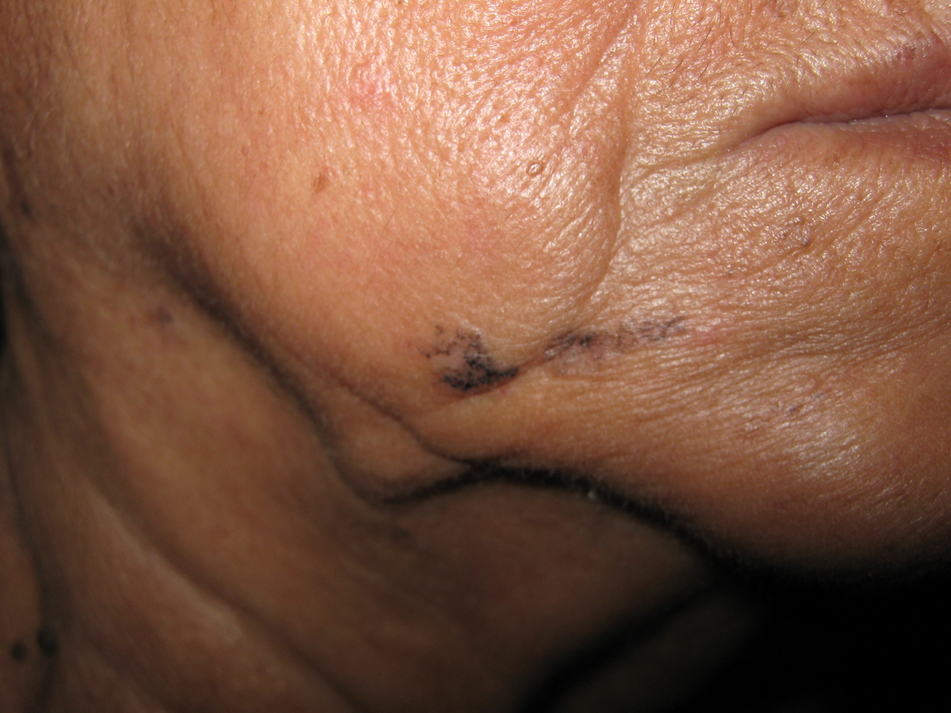 CARCINOMA BASOCELULAR DE LA CARA
