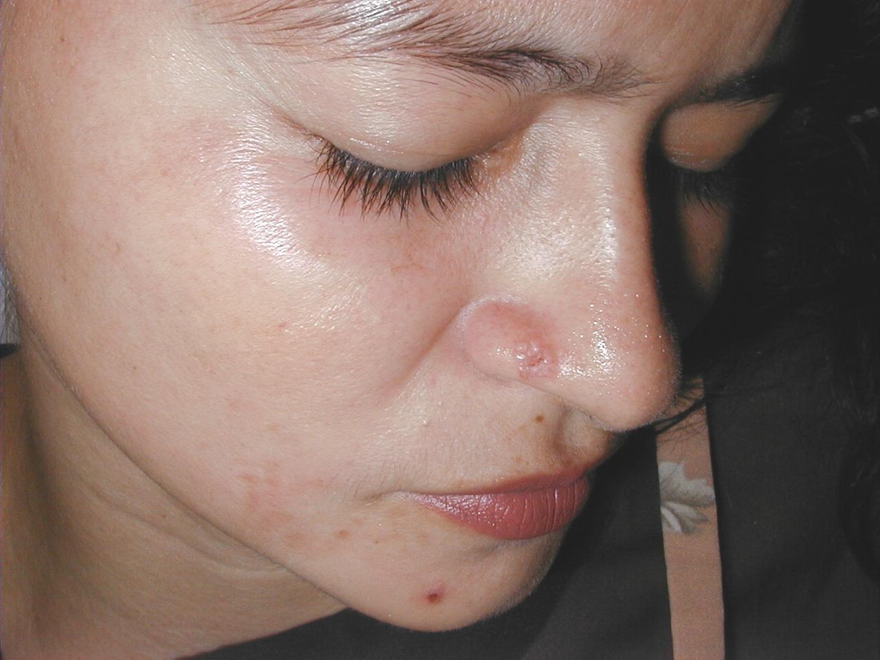 CARCINOMA BASOCELULAR DE LA NARIZ