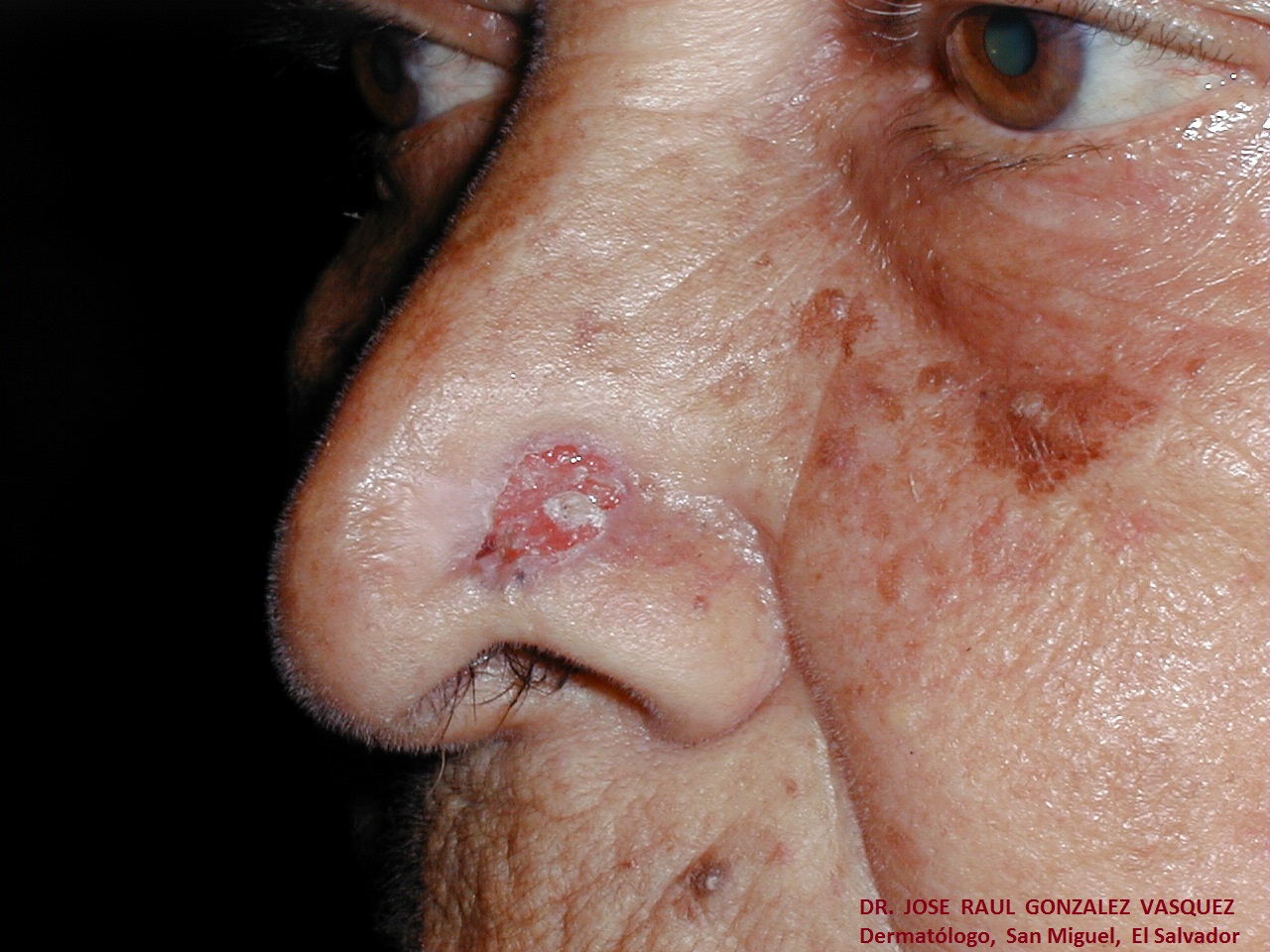 CARCINOMA BASOCELULAR DE LA NARIZ