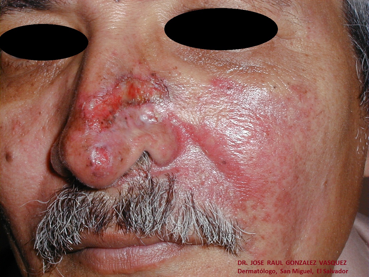 CARCINOMA BASOCELULAR DE LA NARIZ