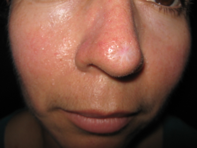 CARCINOMA BASOCELULAR DE LA NARIZ