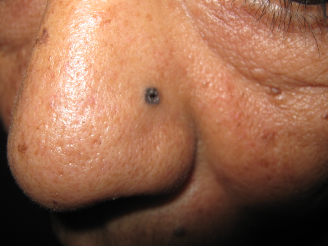 CARCINOMA BASOCELULAR DE LA NARIZ