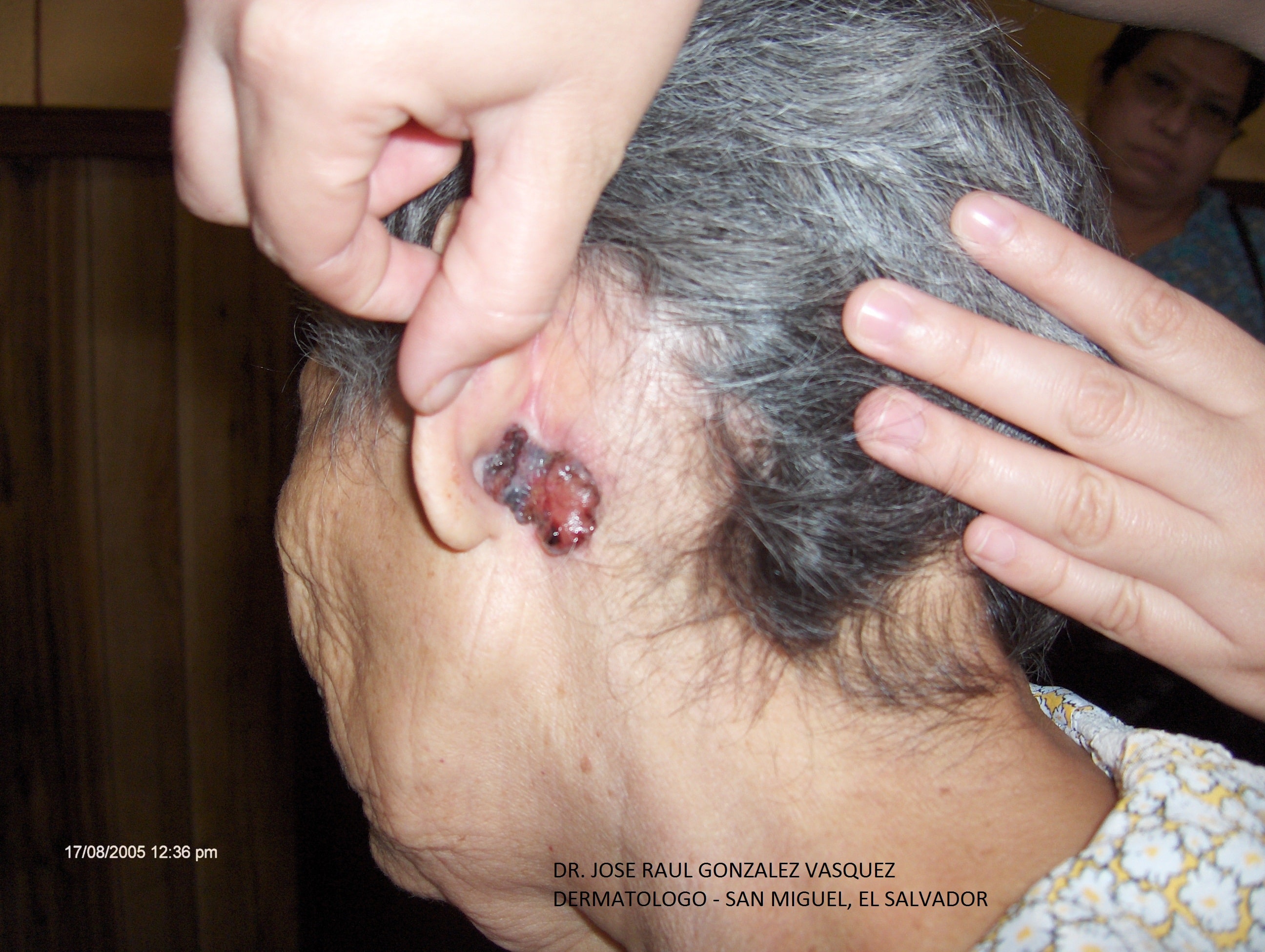 CARCINOMA BASOCELULAR DE LA OREJA