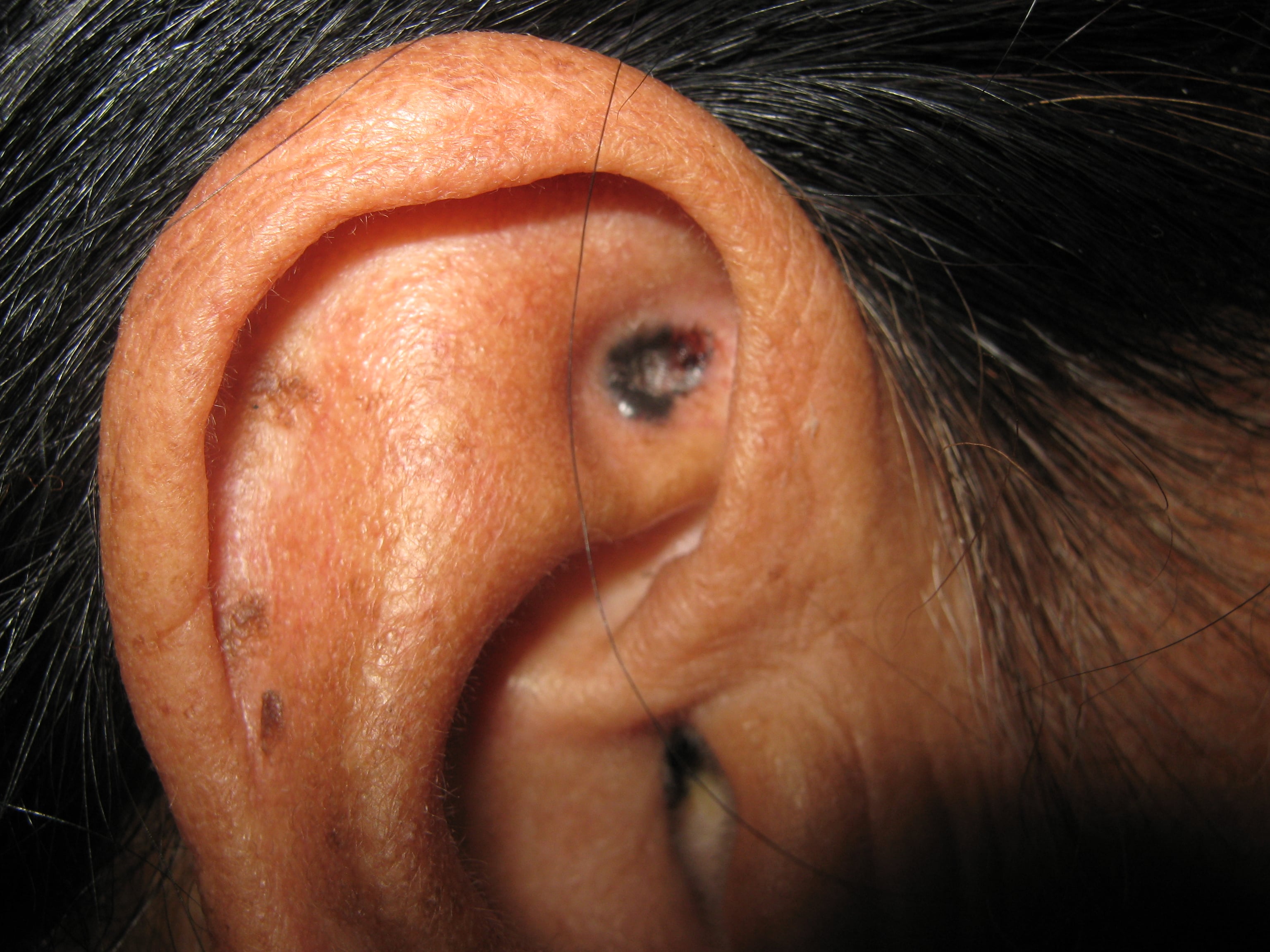 CARCINOMA BASOCELULAR DE LA OREJA