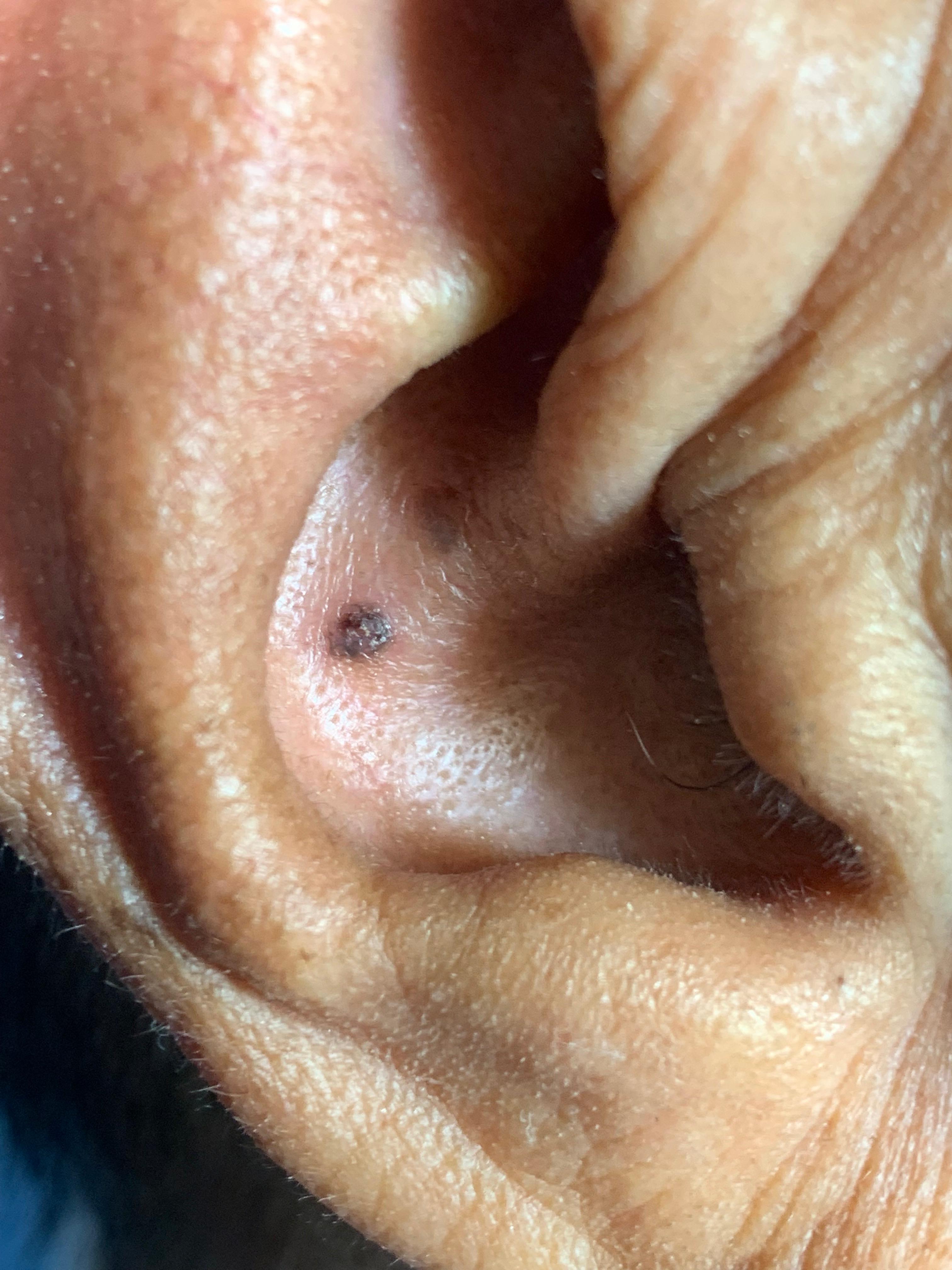 CARCINOMA BASOCELULAR DE LA OREJA