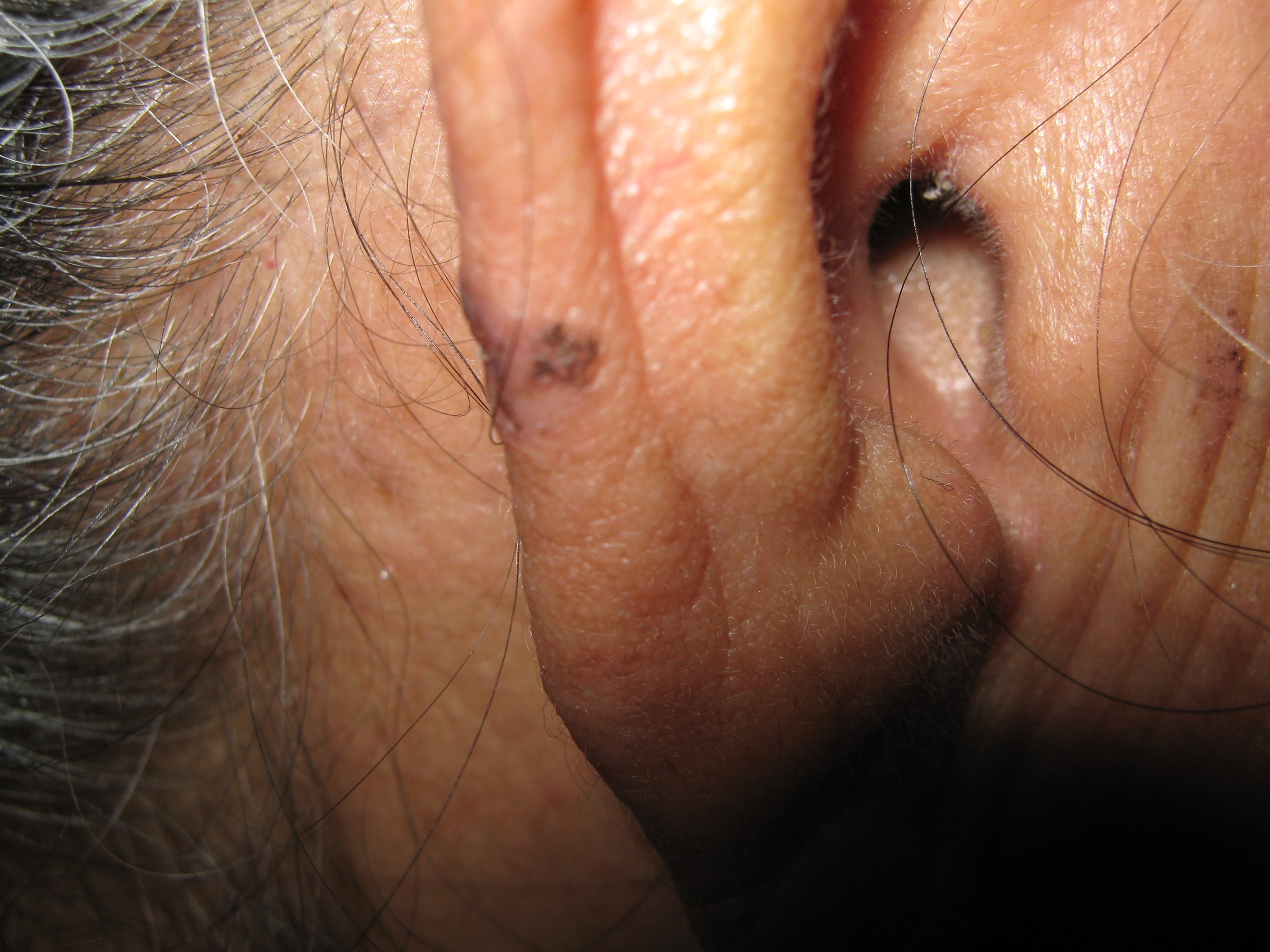 CARCINOMA BASOCELULAR DE LA OREJA