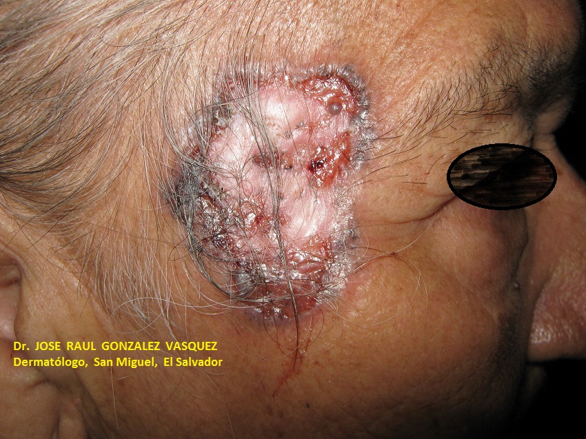 CARCINOMA BASOCELULAR ULCERADO