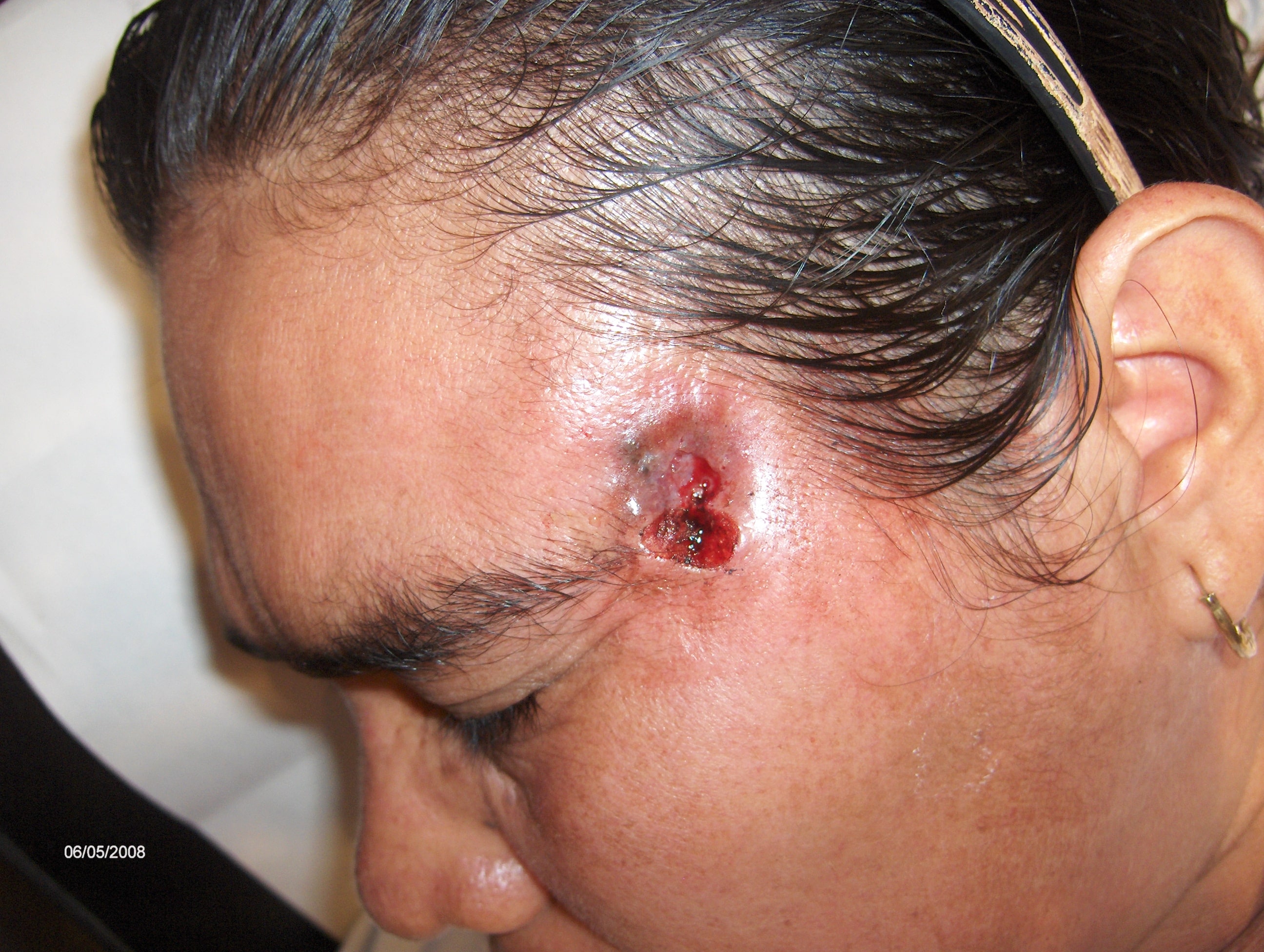 CARCINOMA BASOCELULAR ULCERADO