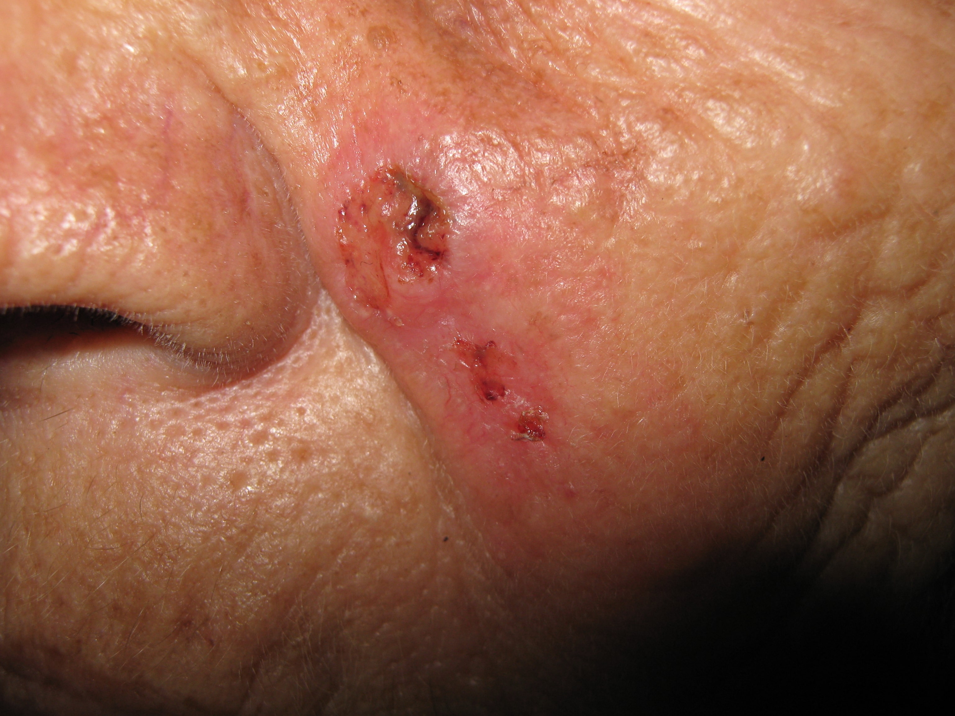 CARCINOMA BASOCELULAR ULCERADO