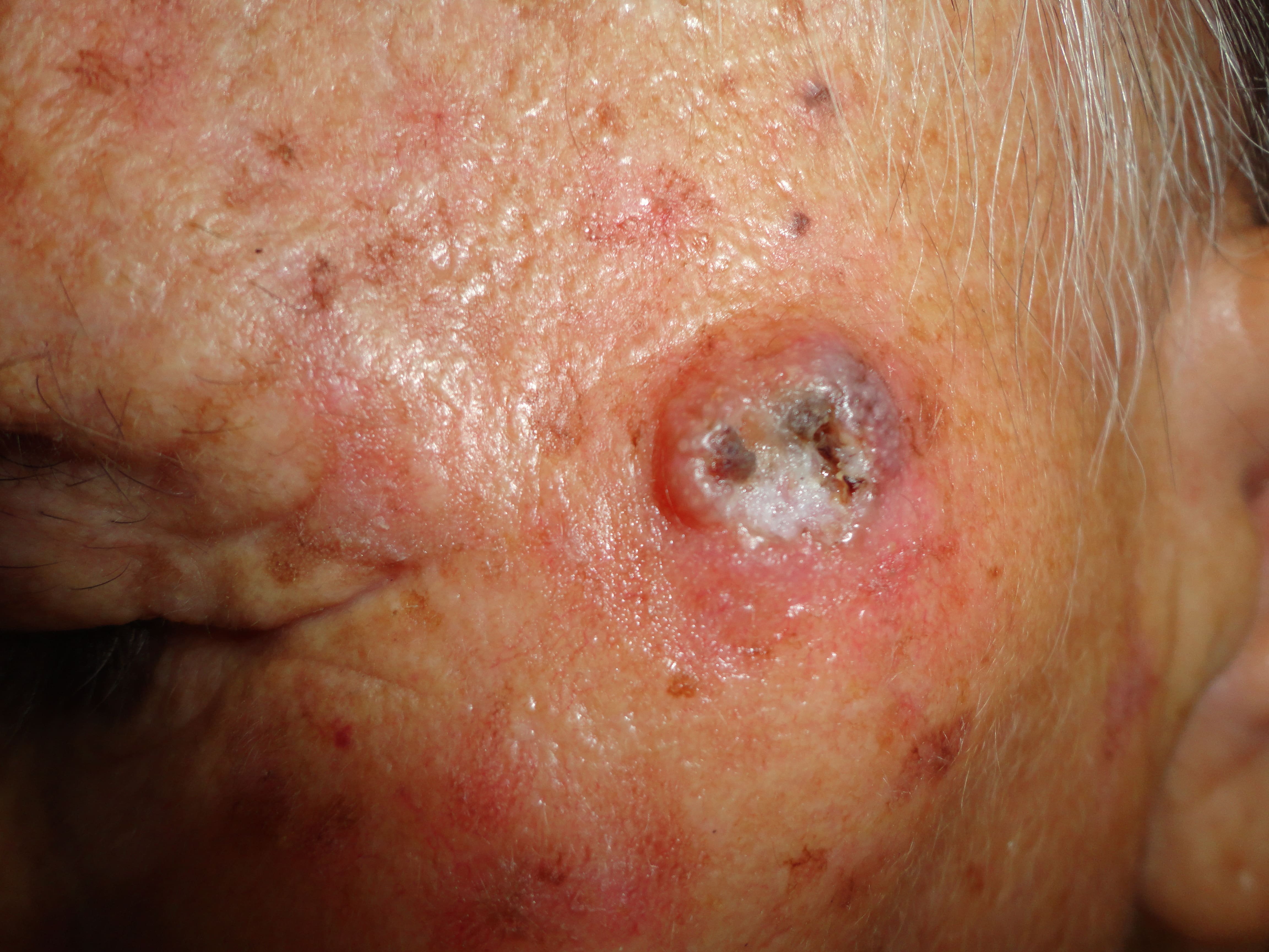 CARCINOMA BASOCELULAR ULCERADO