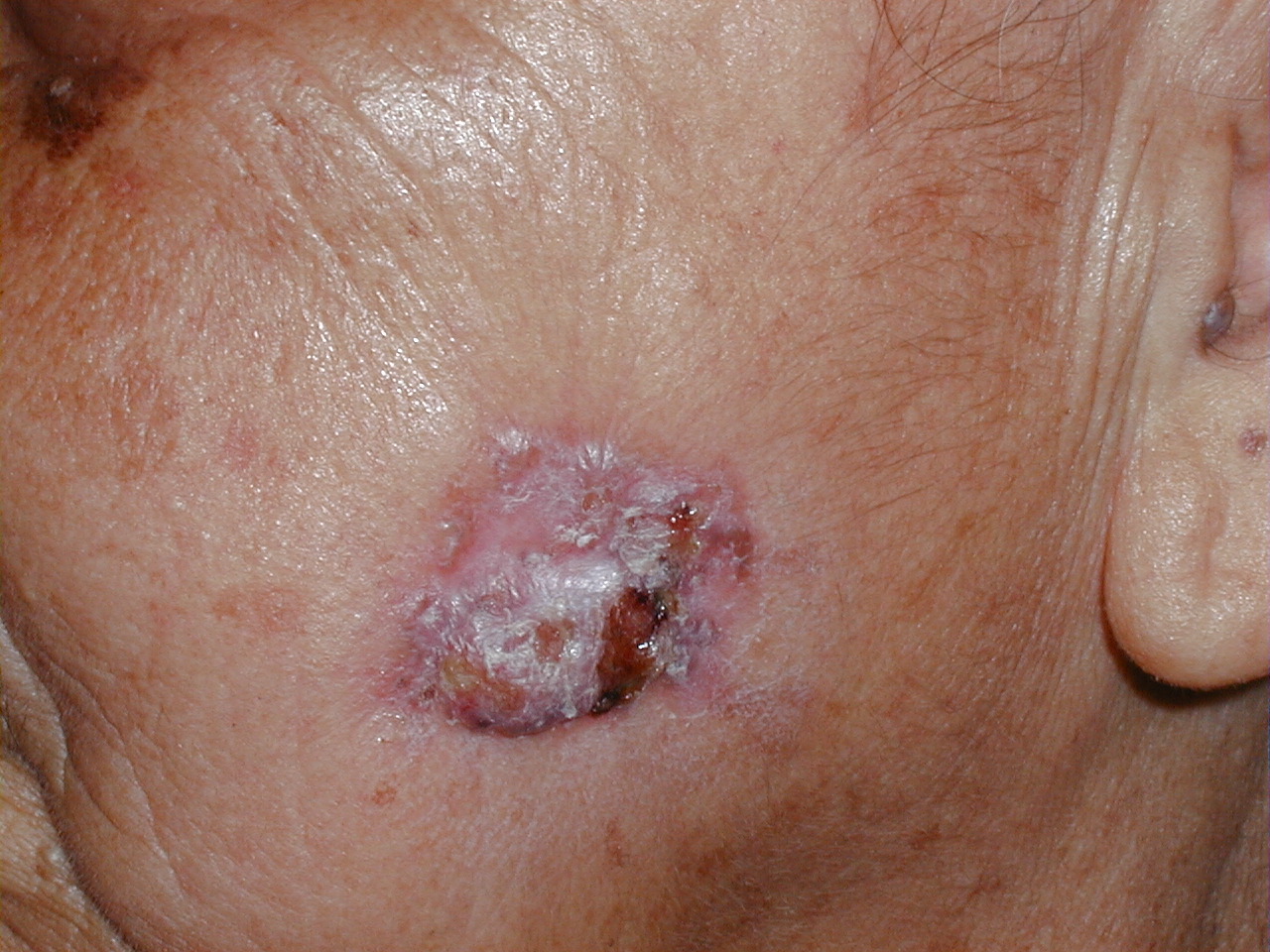 CARCINOMA BASOCELULAR ULCERADO