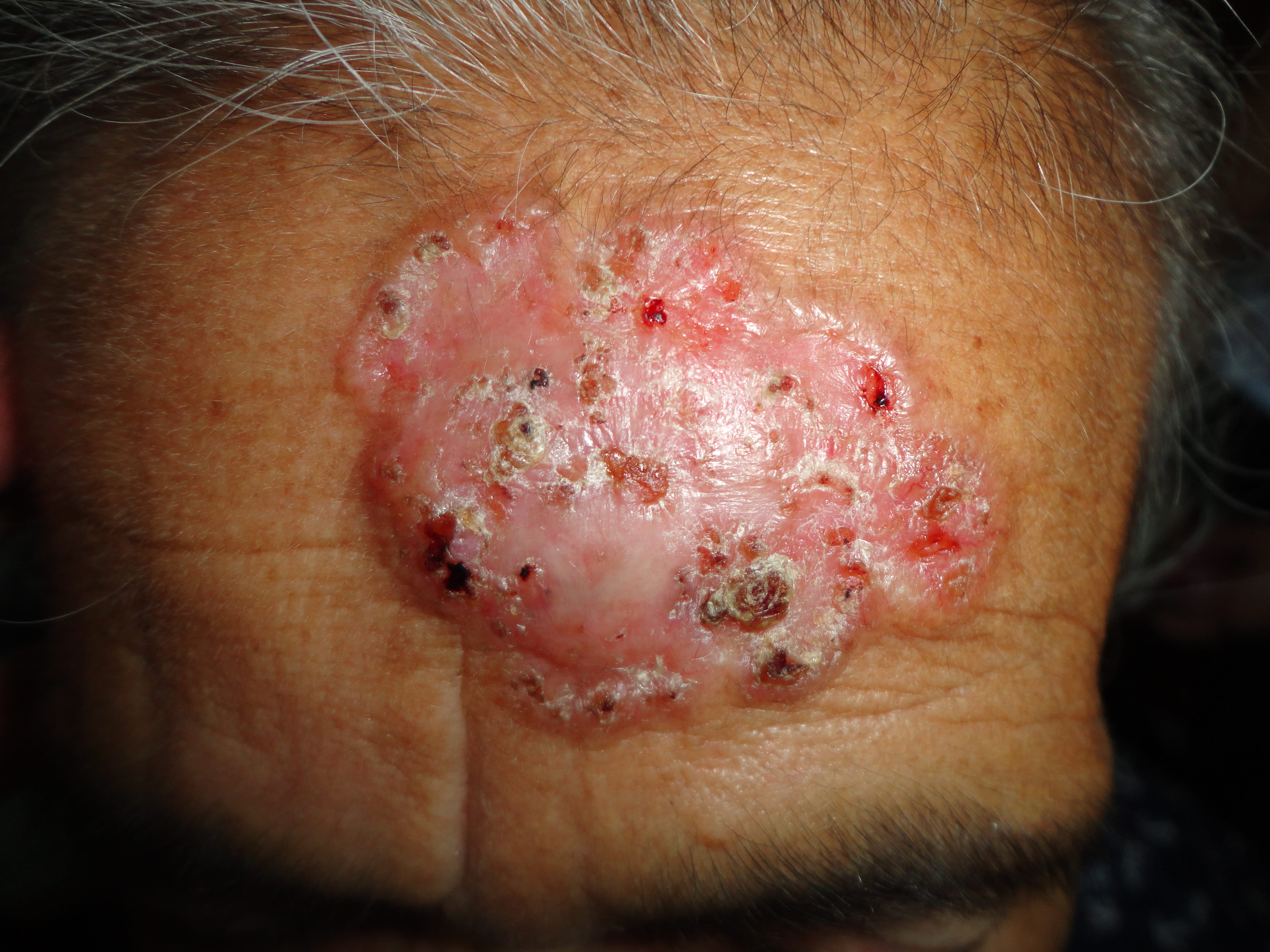 CARCINOMA BASOCELULAR ULCERADO