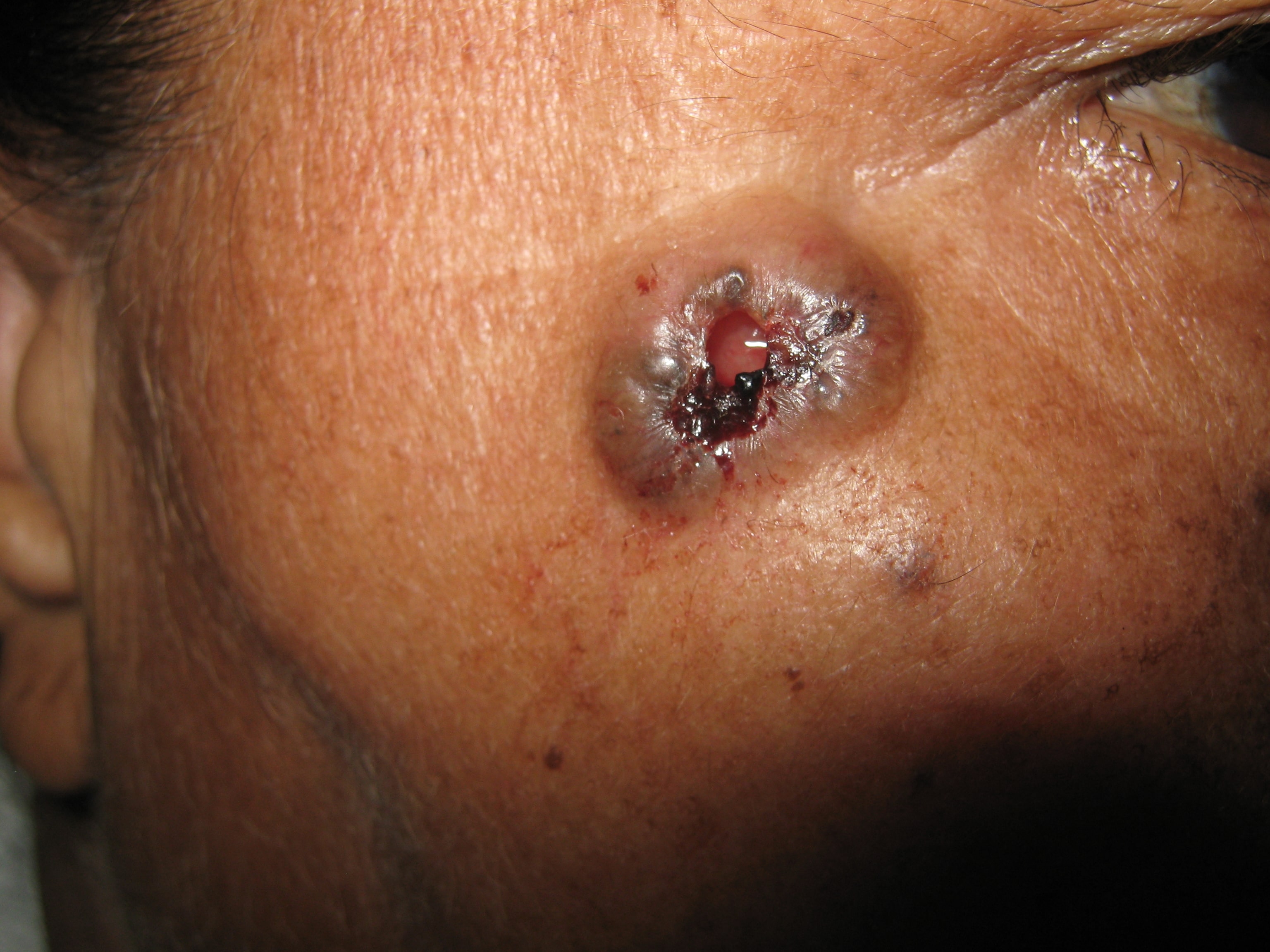 CARCINOMA BASOCELULAR ULCERADO