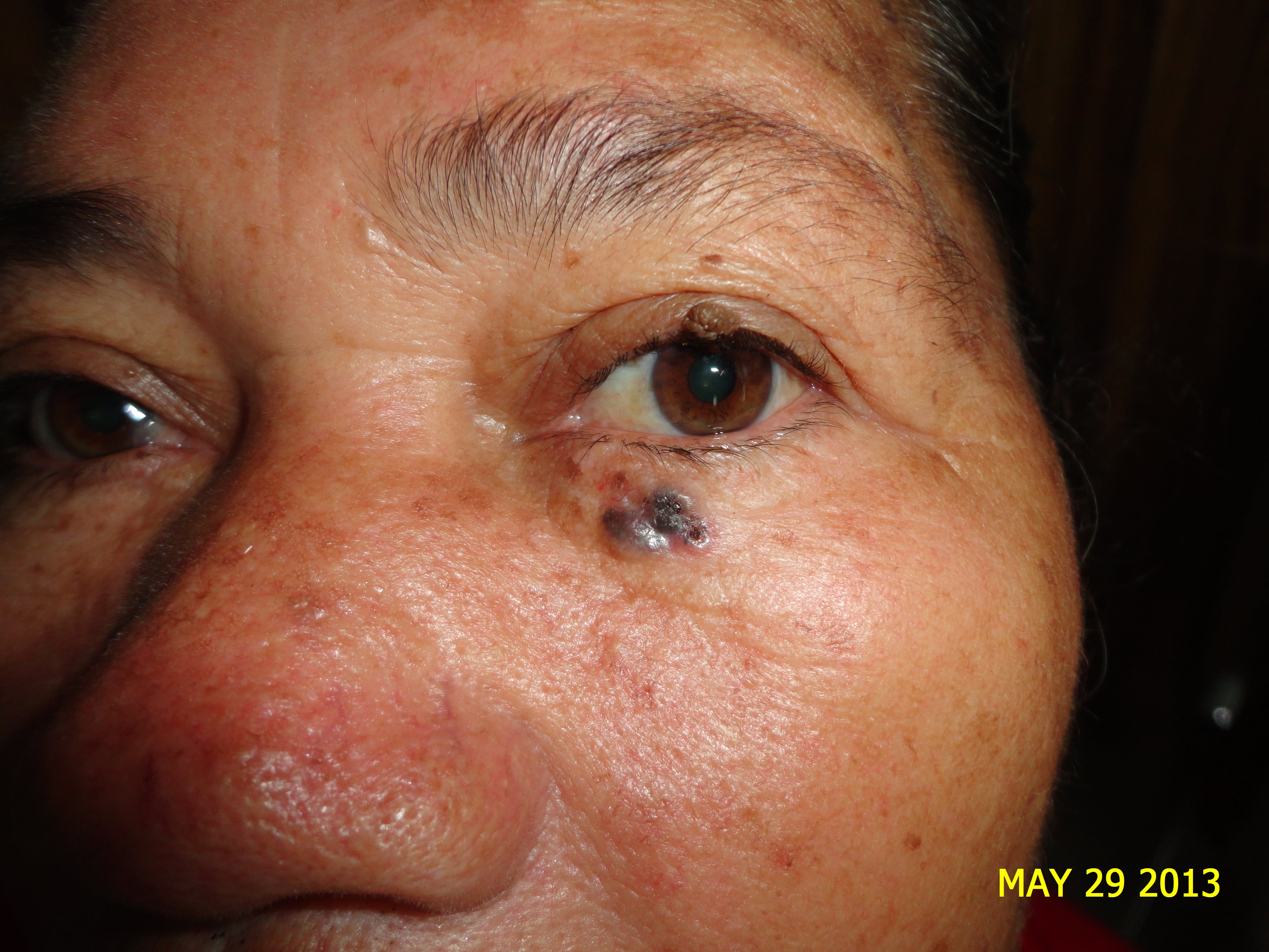 CARCINOMA BASOCELULAR DE PARPADO