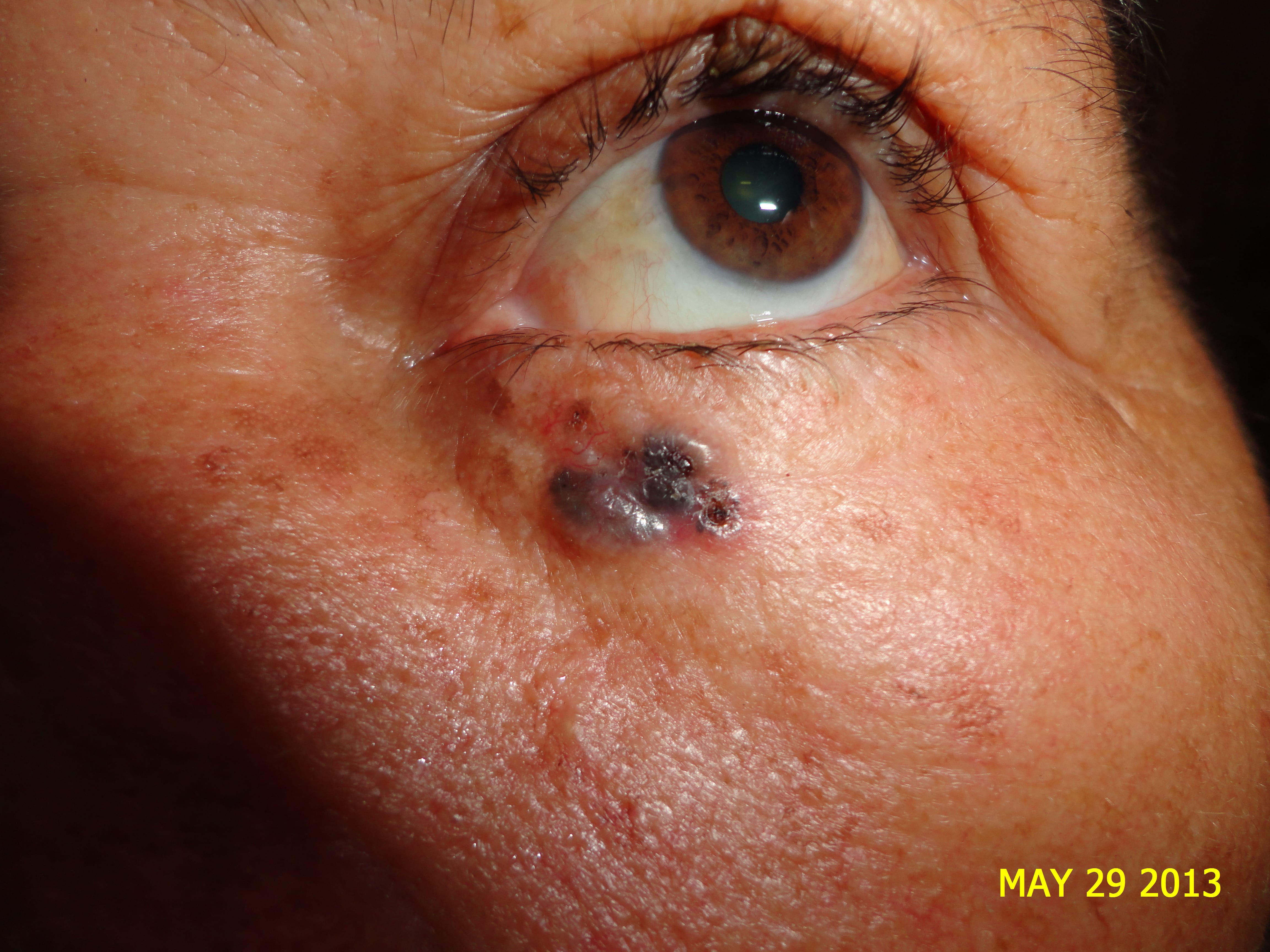 CARCINOMA BASOCELULAR DE PARPADO