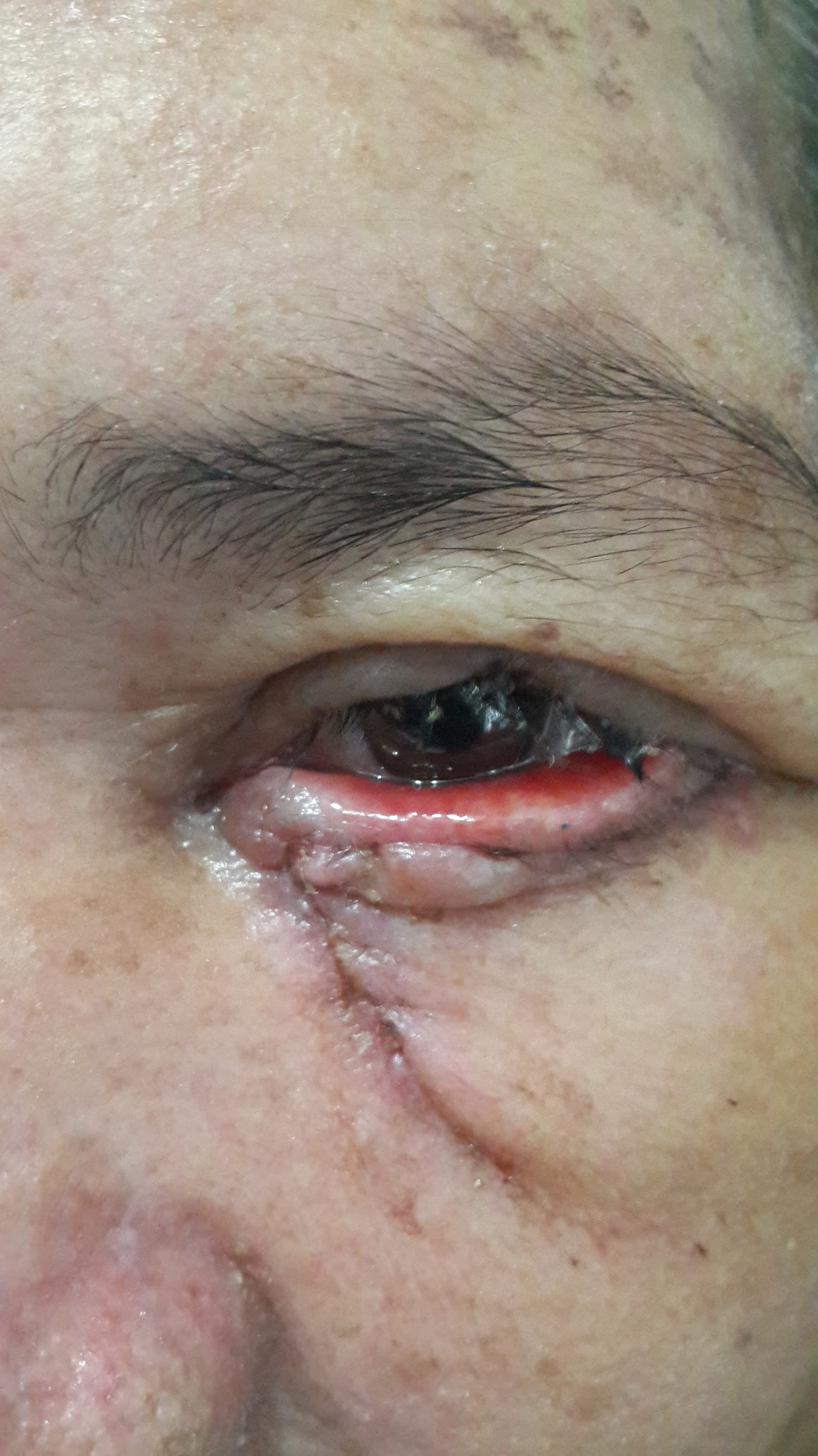 CARCINOMA BASOCELULAR y COLGAJOS