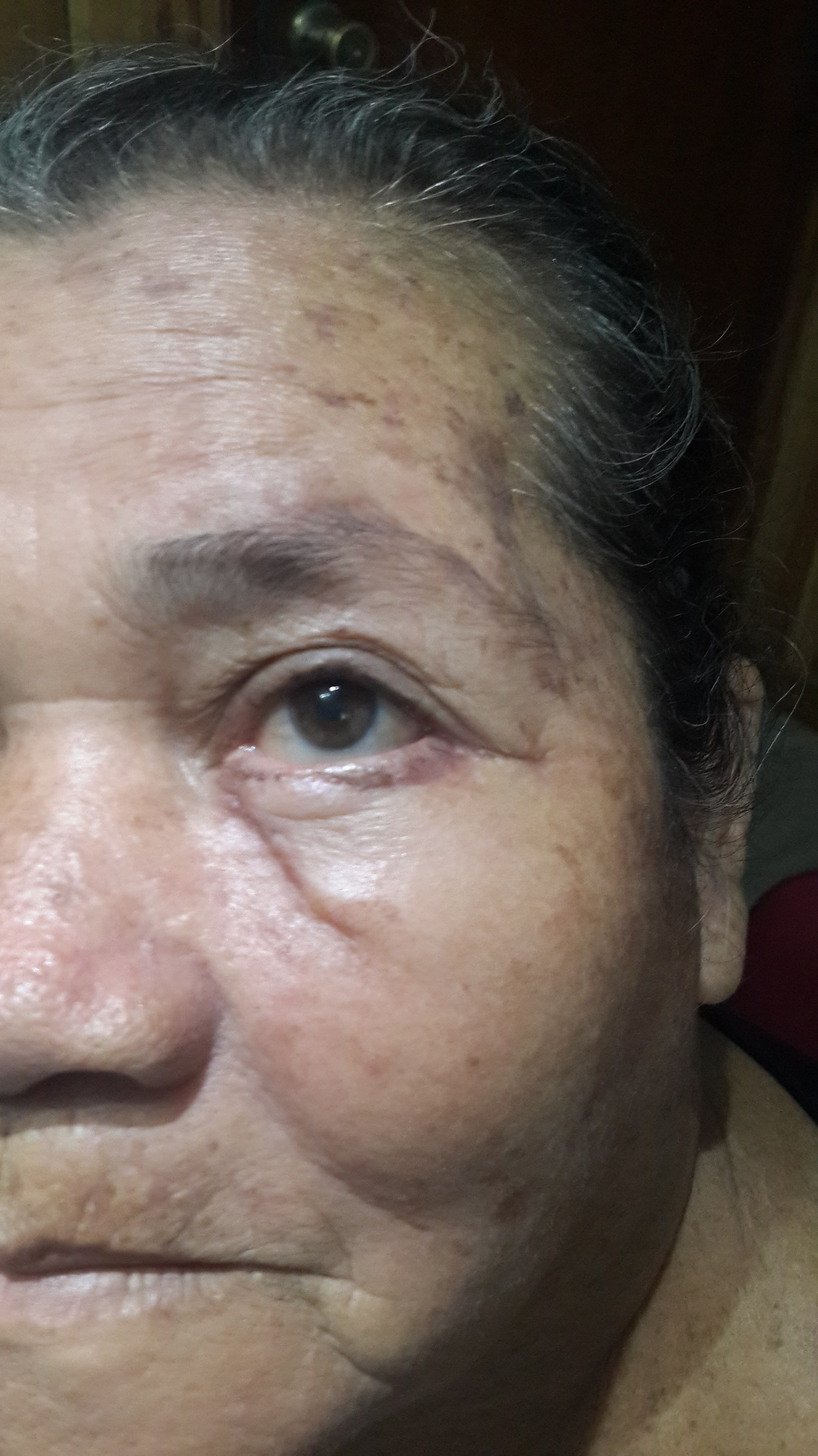 CARCINOMA BASOCELULAR y COLGAJOS